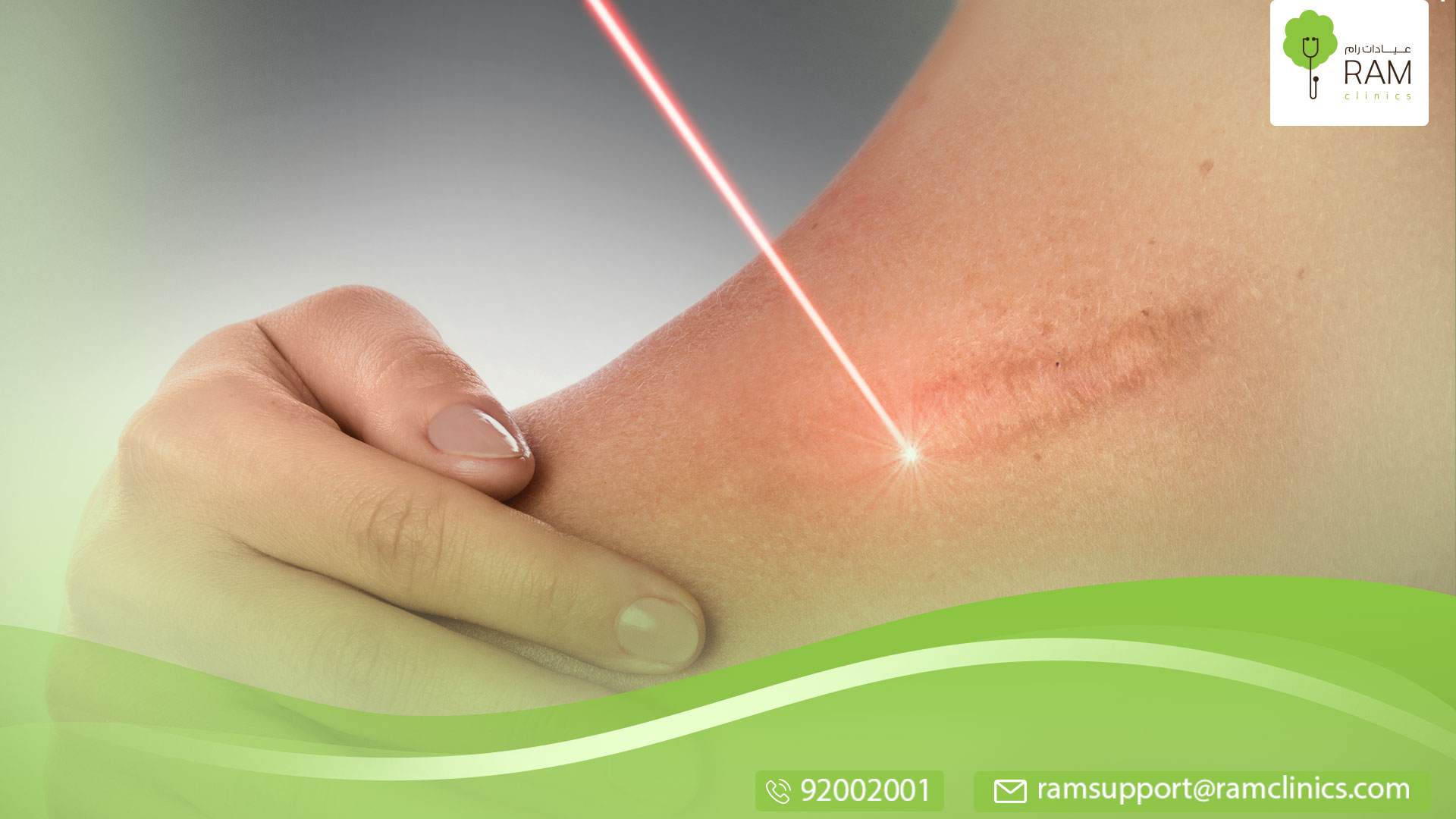 علاج الندبات بالليزر