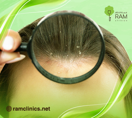 علاج الصدفية بزيت الزيتون