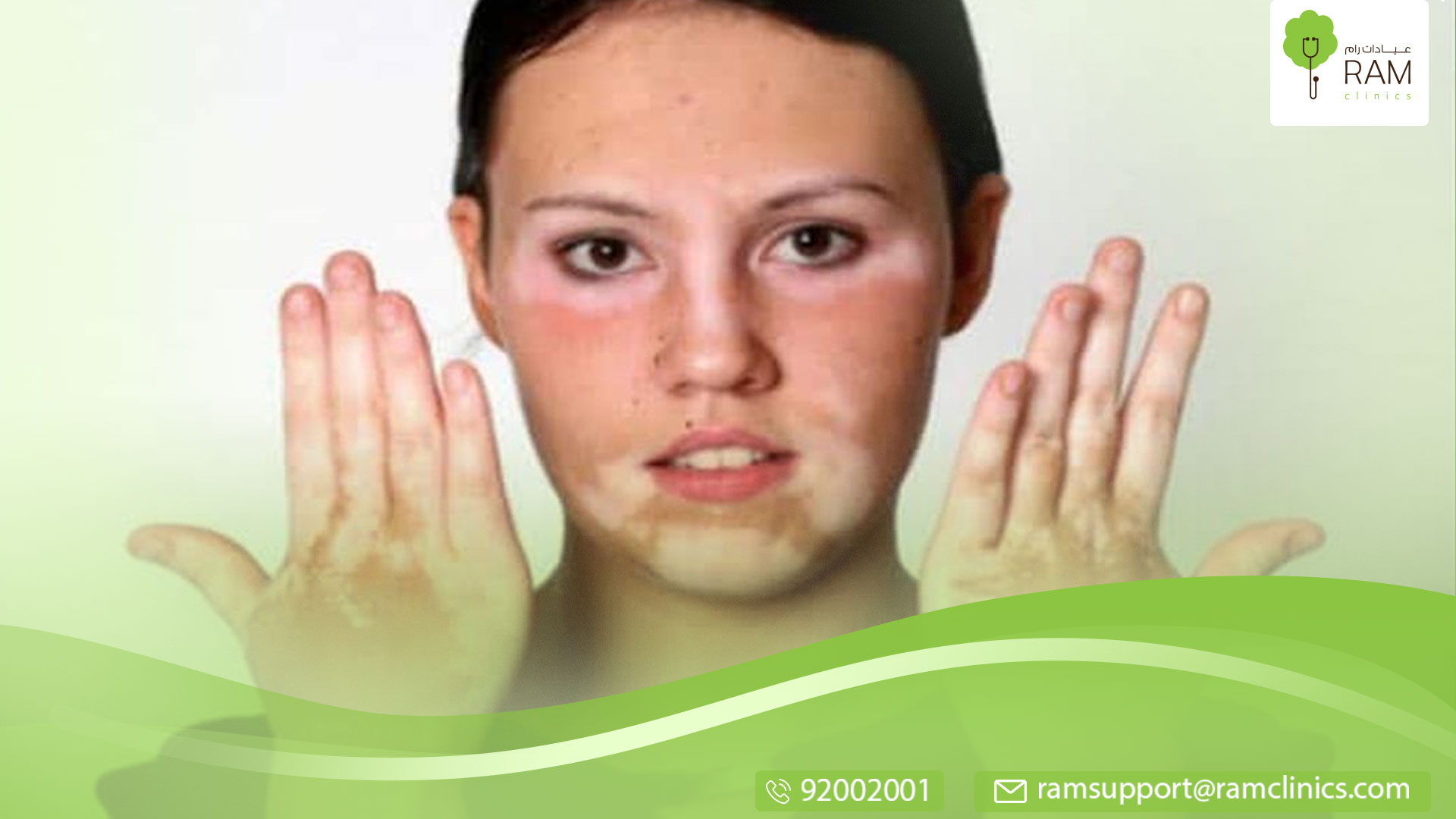 مراحل ظهور البهاق