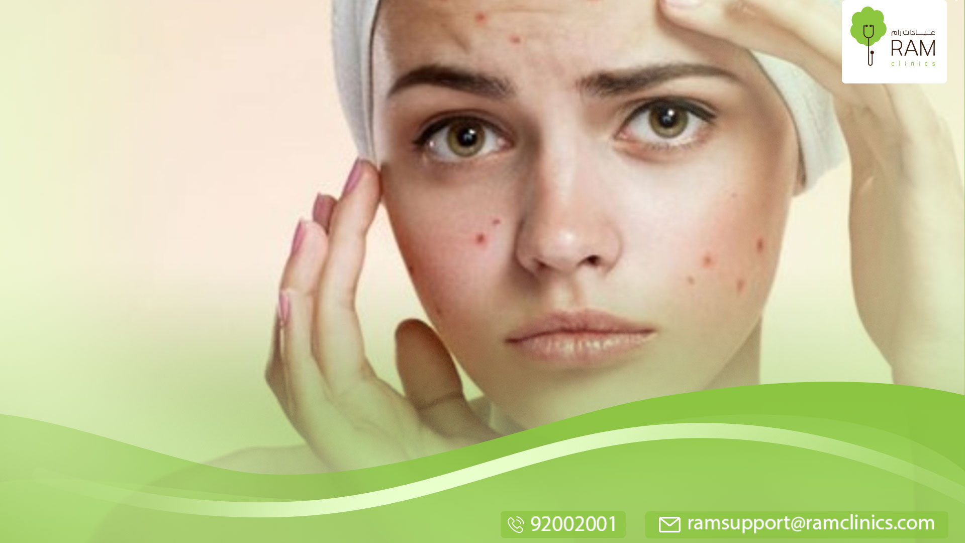 وصفة الأسبرين لحب الشباب