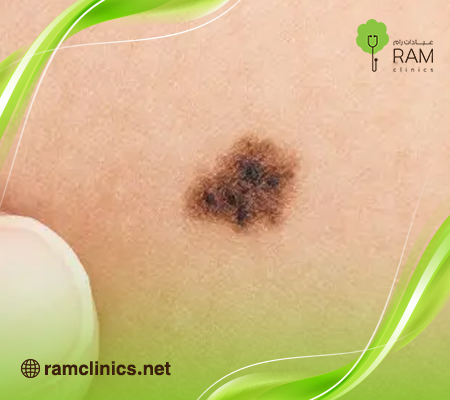 الشامات دليل كامل