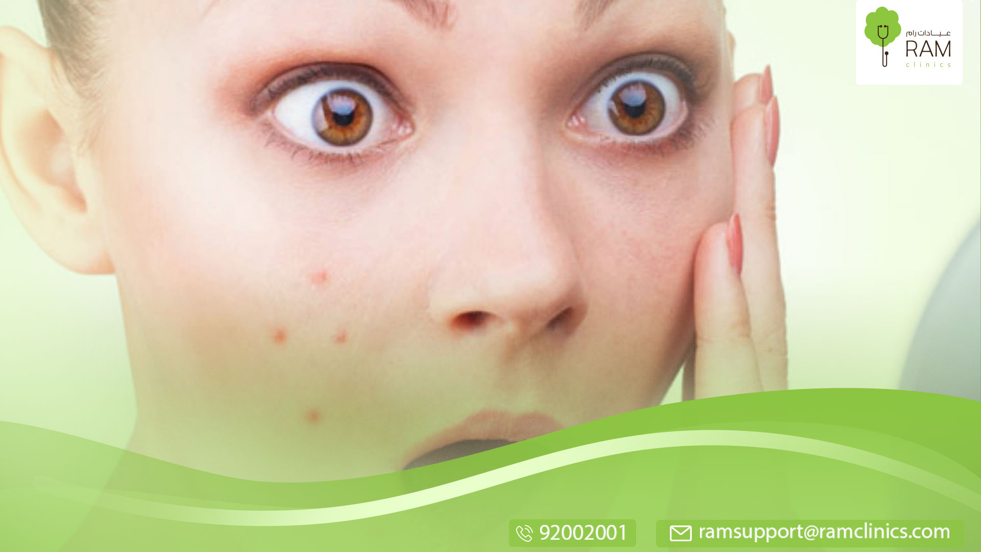 ما هو حب الشباب المستعصي