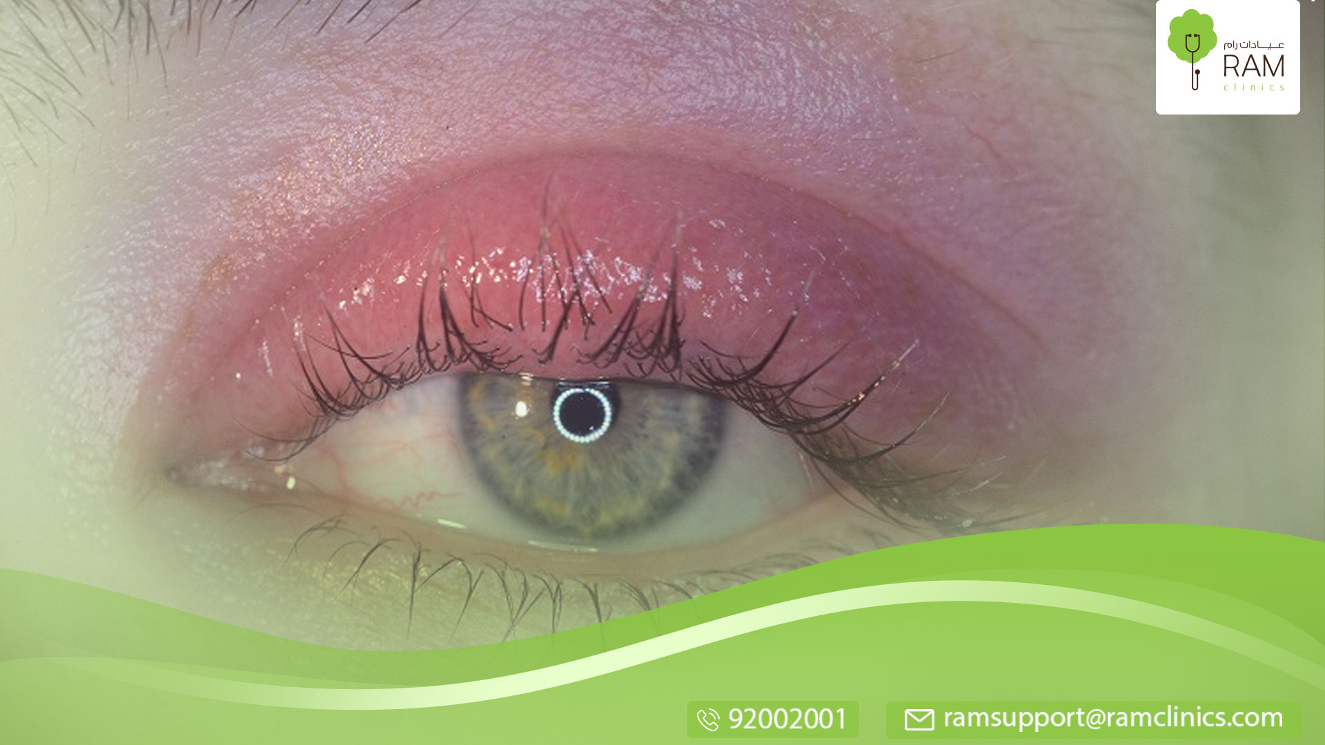 التهاب الجفون