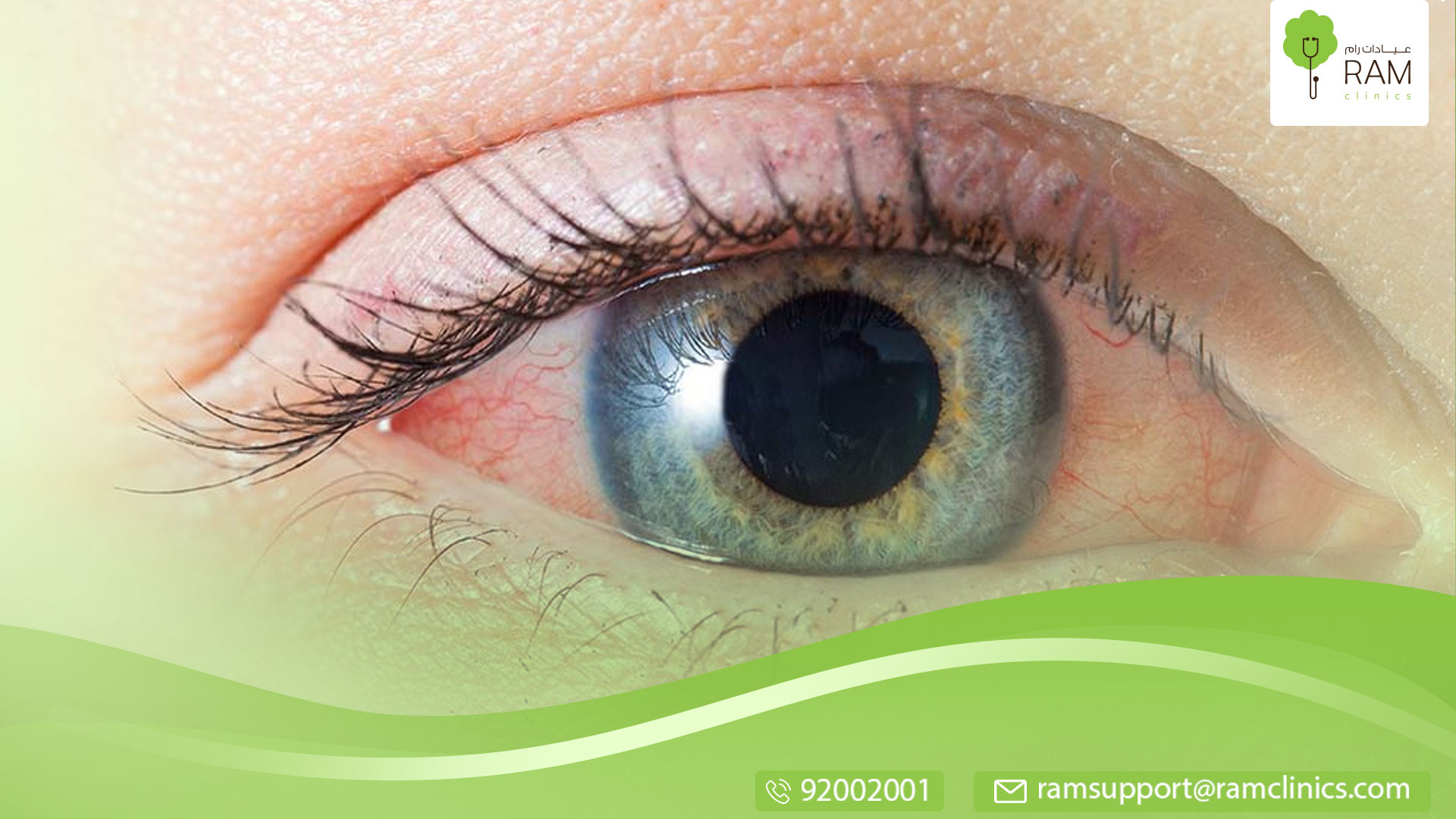 التهاب العين