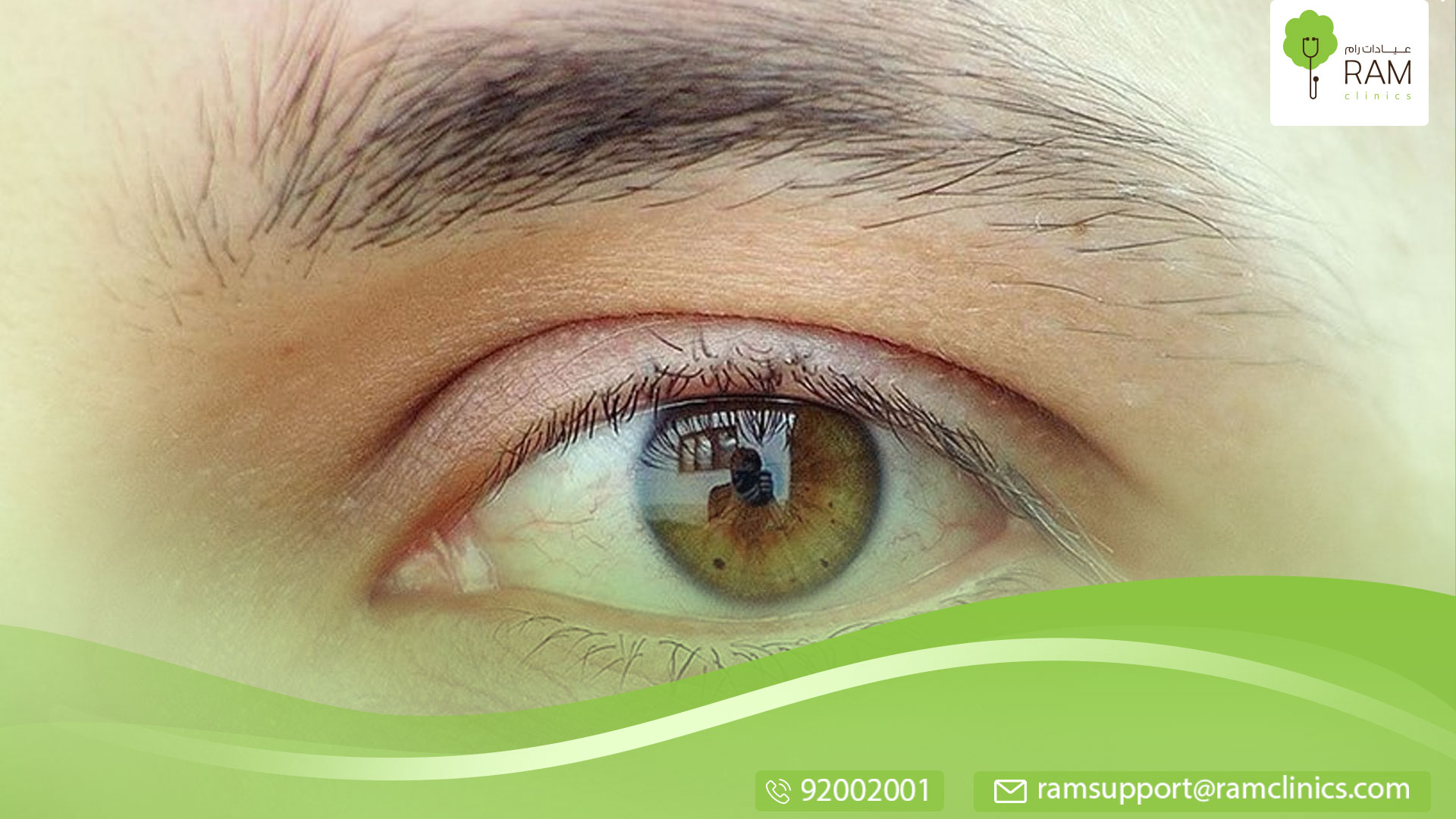 حروق العين بسبب الشمس