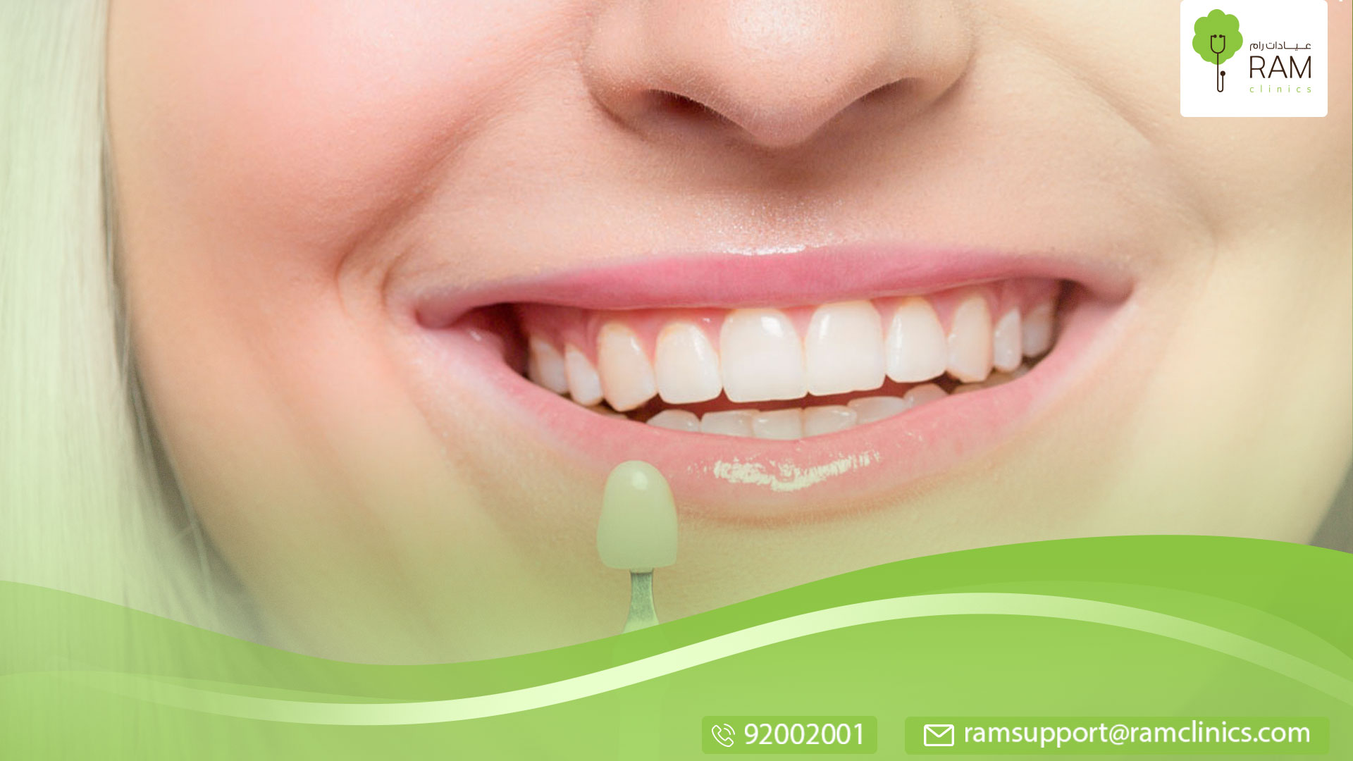 معلومات عن الفينير للأسنان