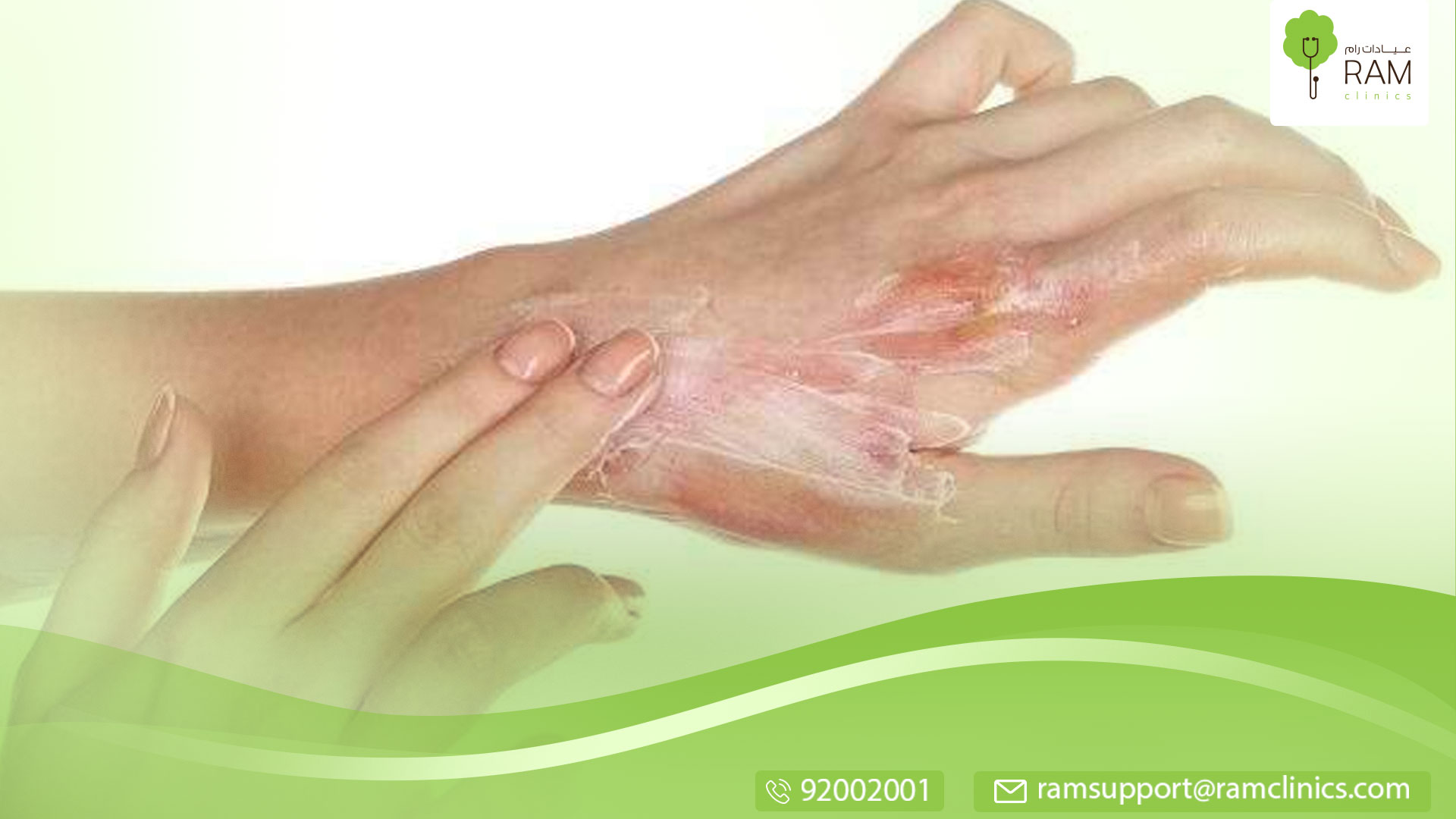 علاج آثار الحروق والندبات