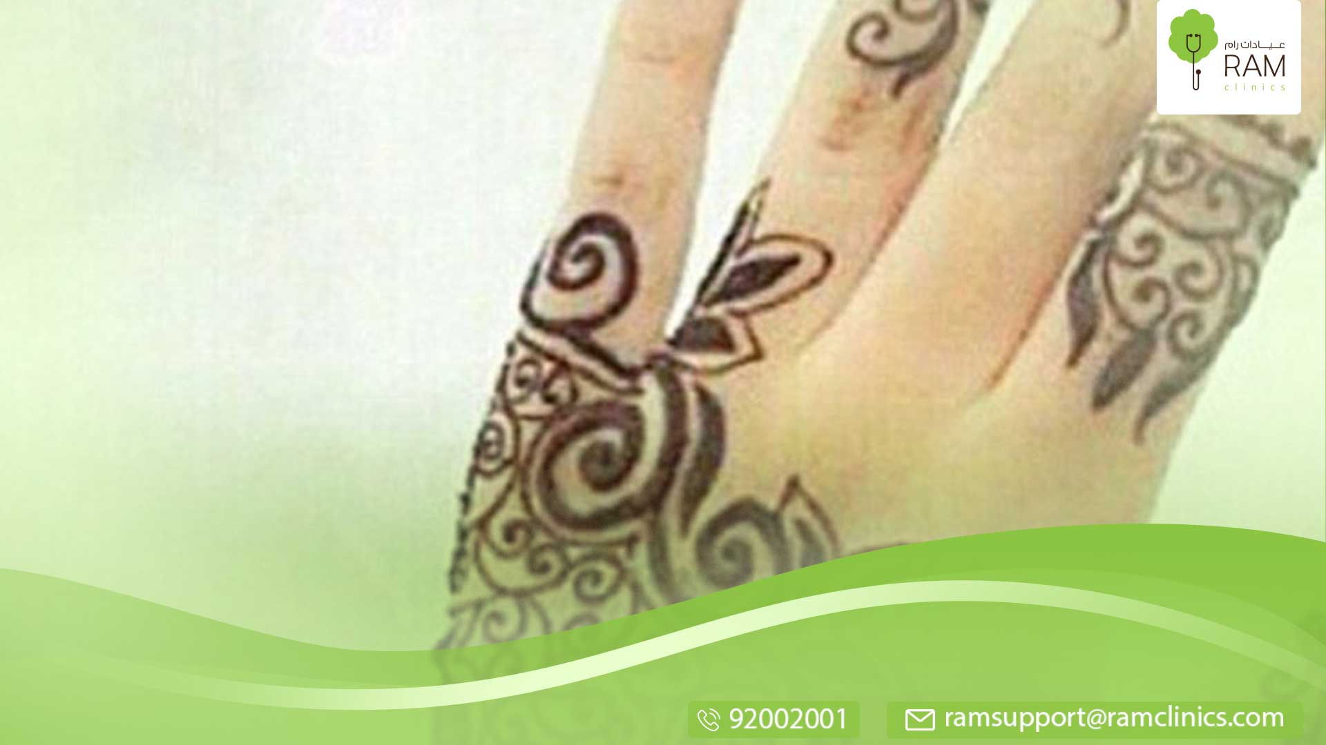 الحناء السوداء تسبب ندوباً خطيرة لطفل