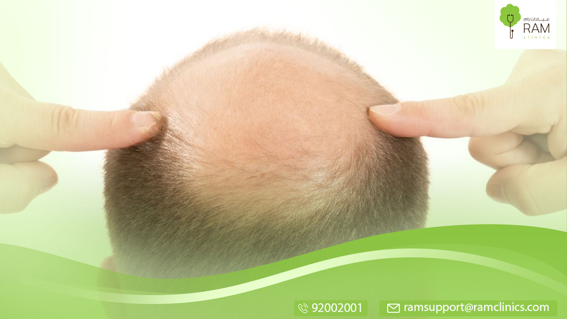 علاج الصلع عند الرجال