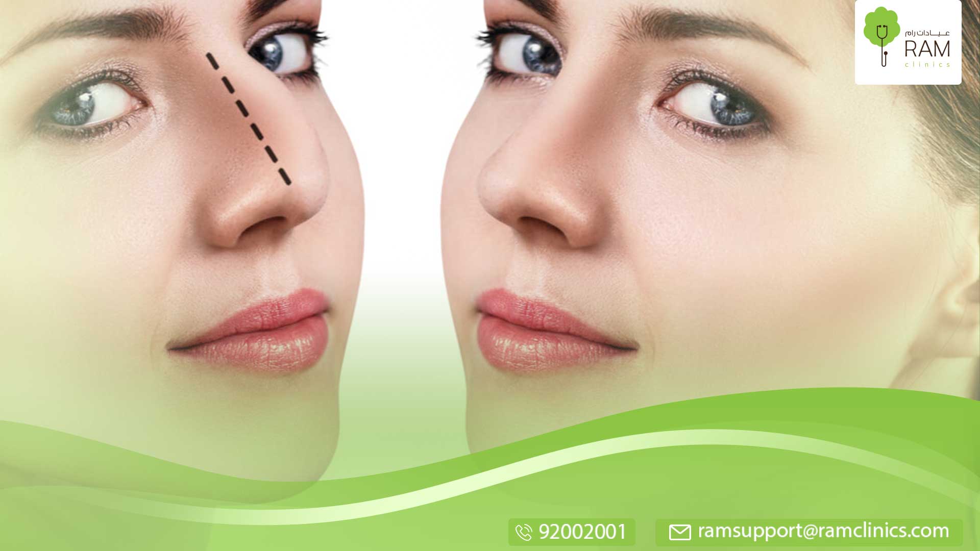 إذابة دهون الأنف