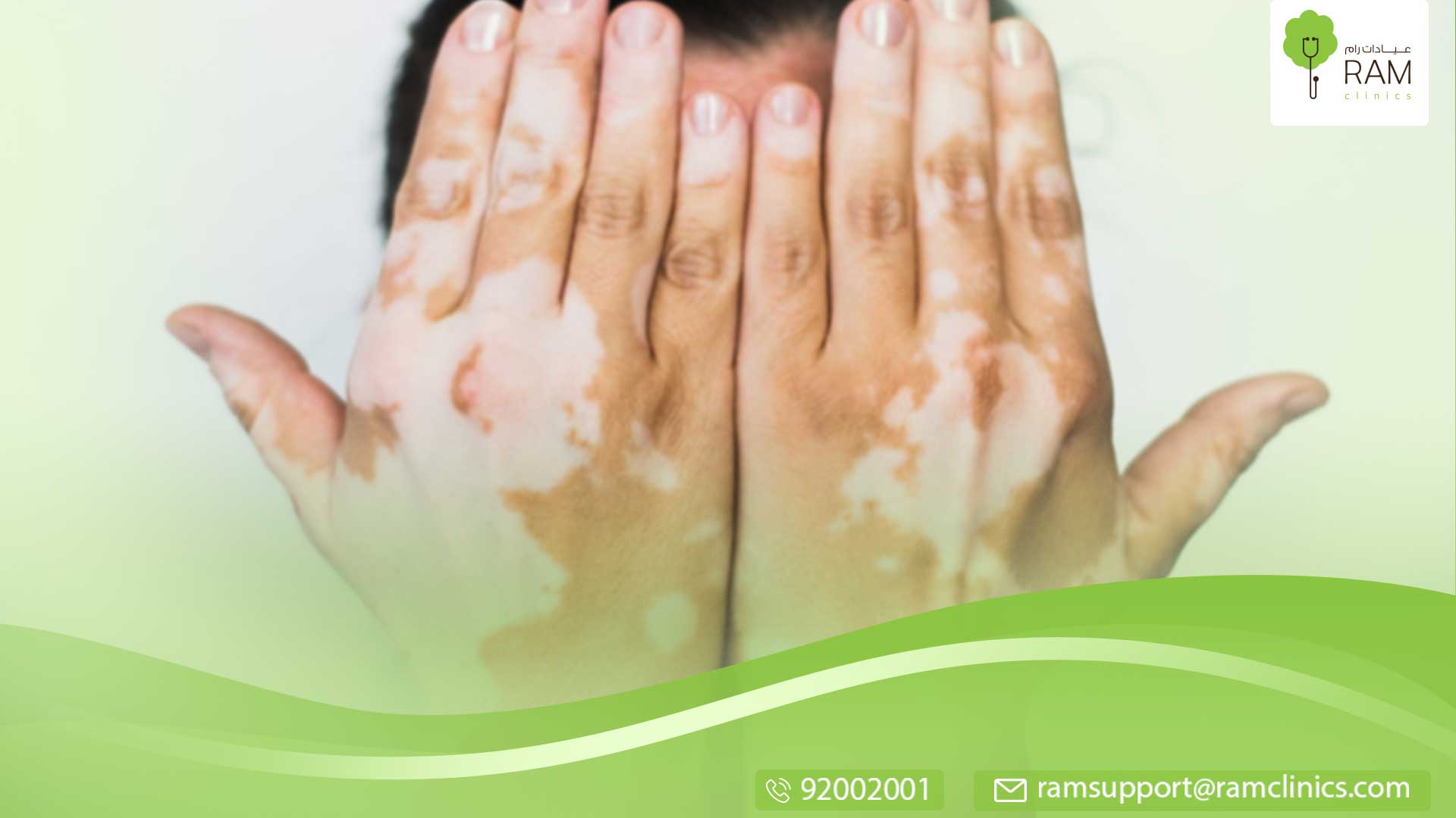 ما هو معني البهاق الأسود