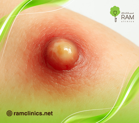 الدمل والخراج