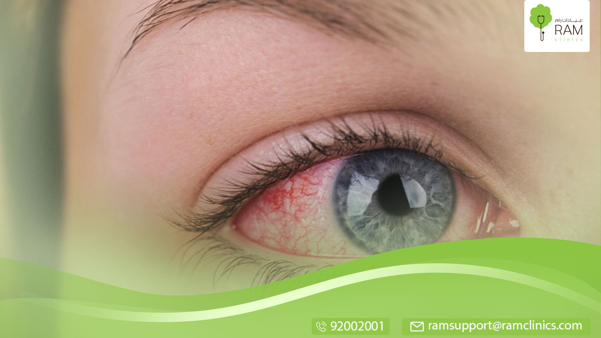 التهاب جفني العين