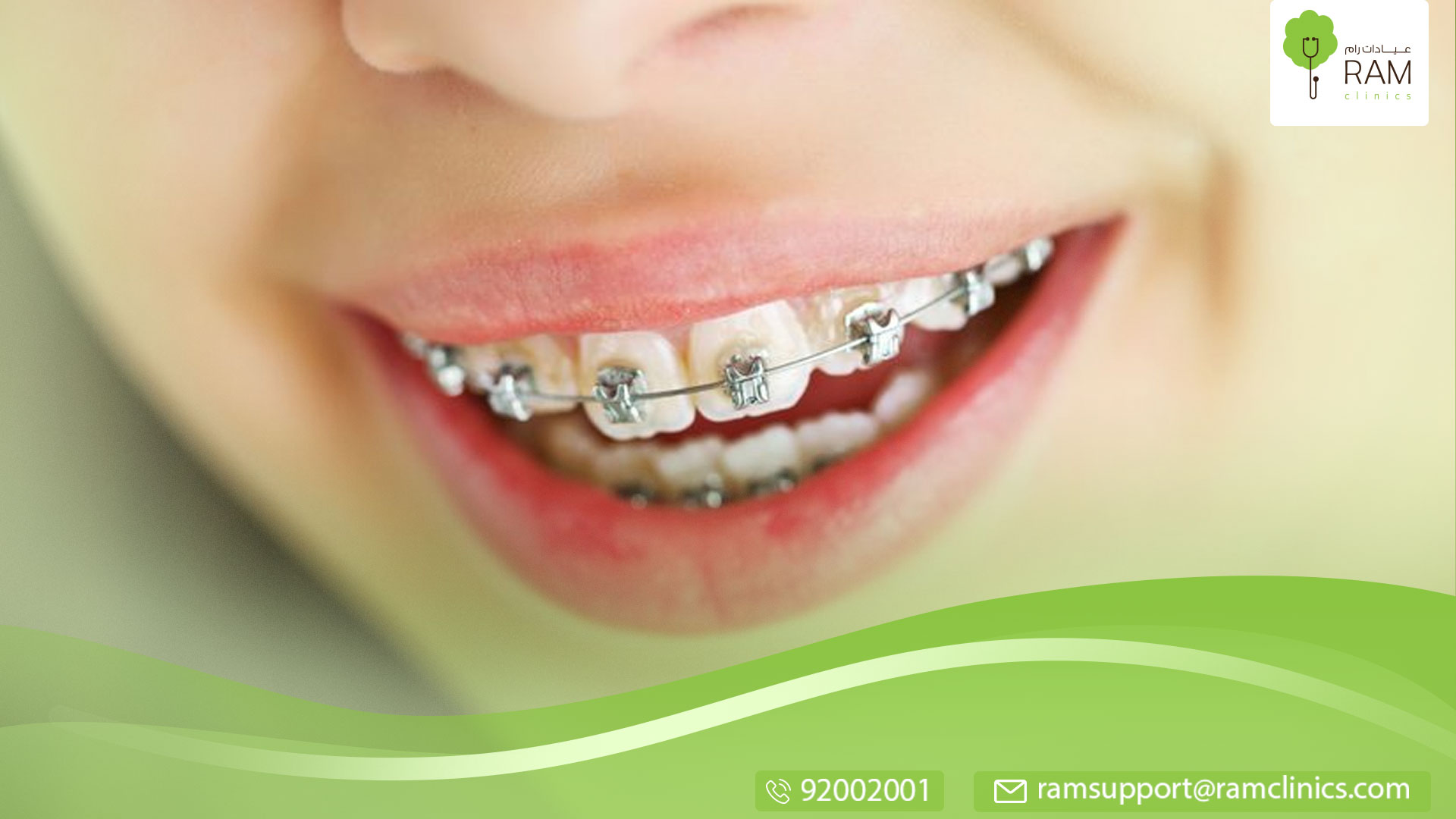 العمر المناسب لعمل لتقويم الأسنان