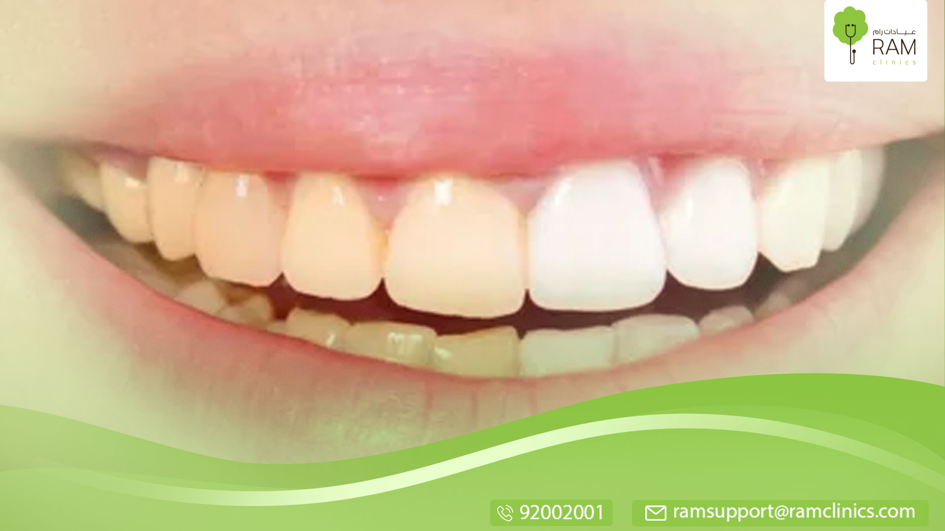 طرق منزلية للتخلص من الأسنان الصفراء