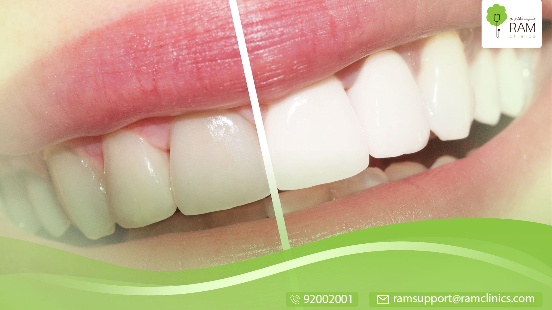 طرق مستخدمة في تبييض الأسنان في المنزل