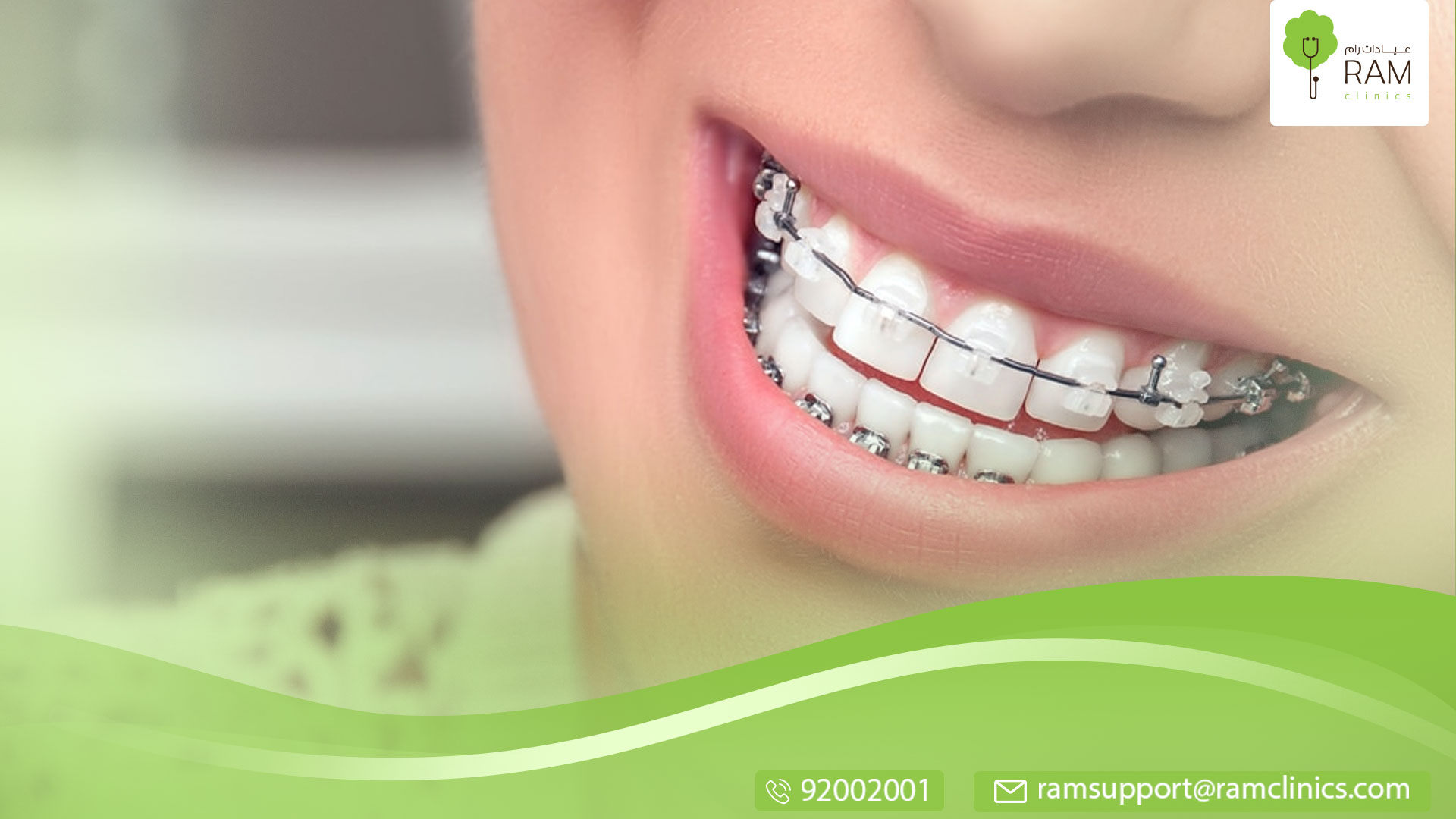 أنواع تقويم الأسنان ومعلومات أخرى هامة