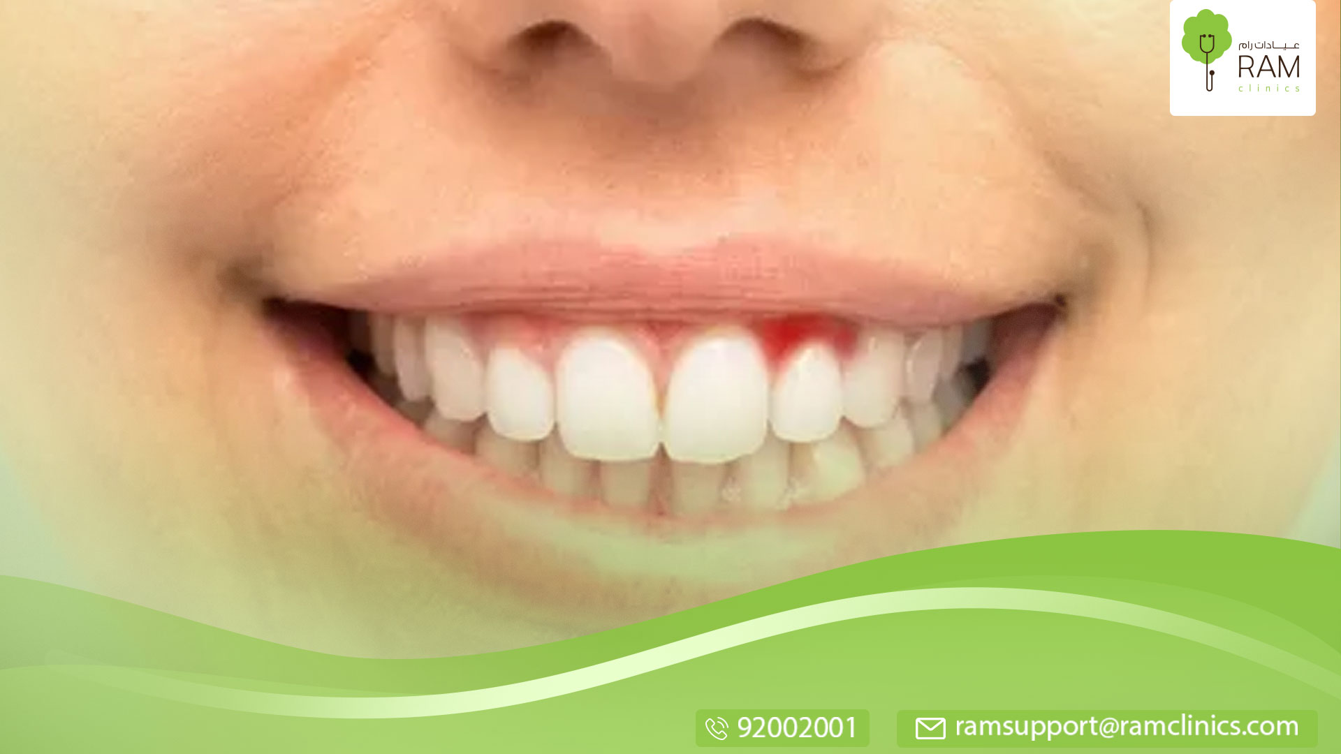 علاج نزيف اللثة