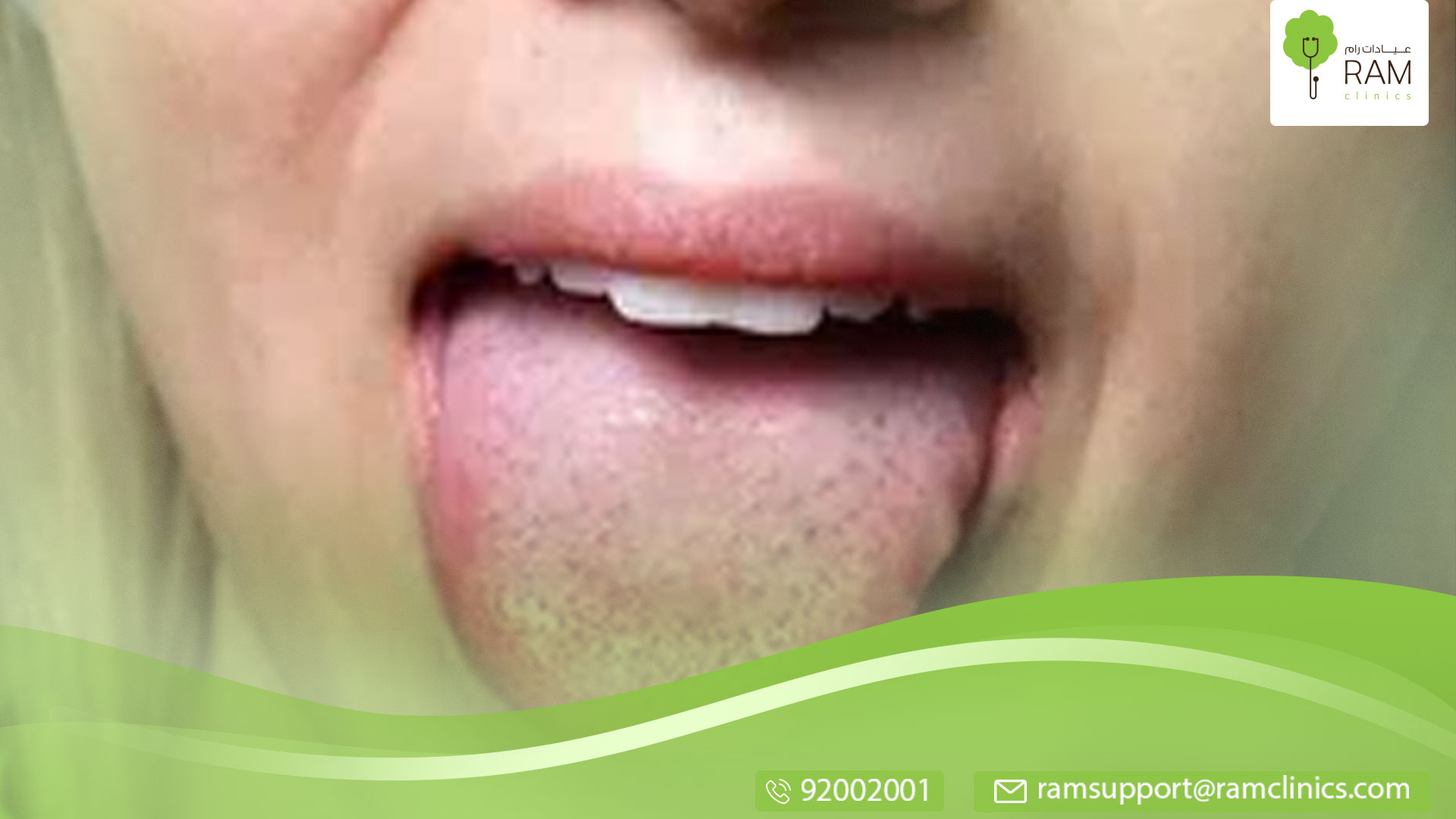 تعرف على علاج حبوب اللسان