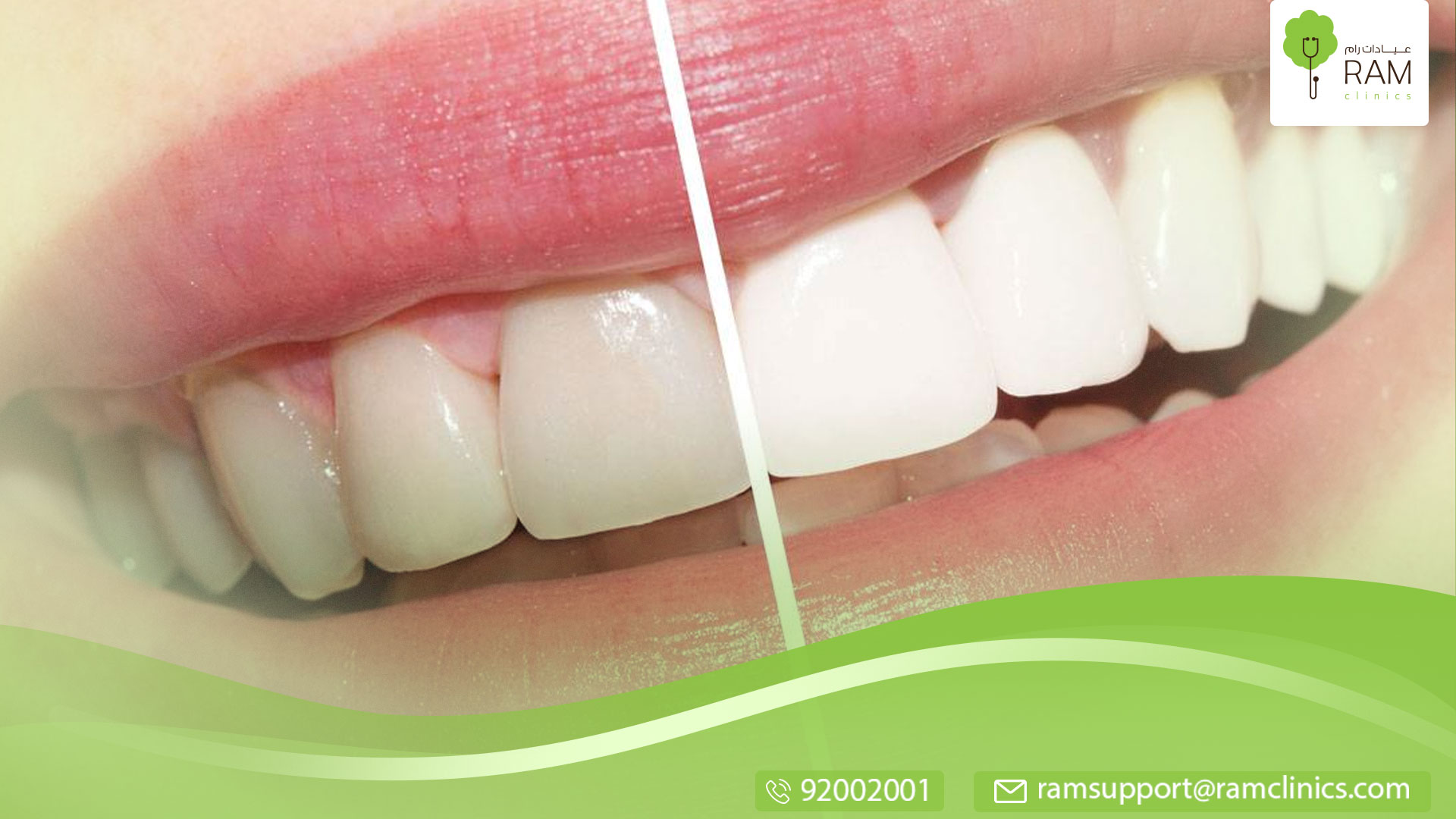 علاج حساسية الأسنان بعد التبييض