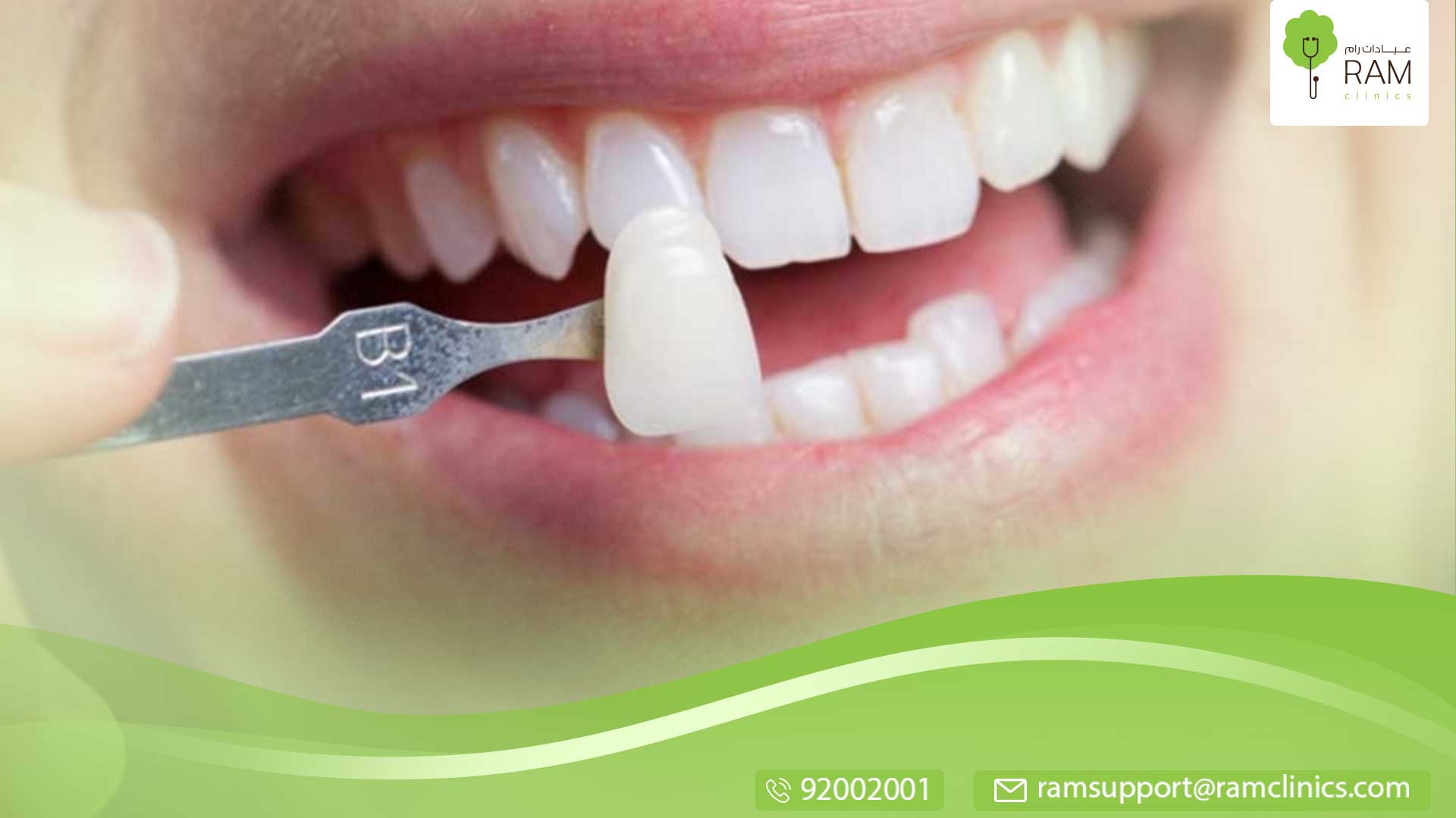 العدسات اللاصقة للأسنان