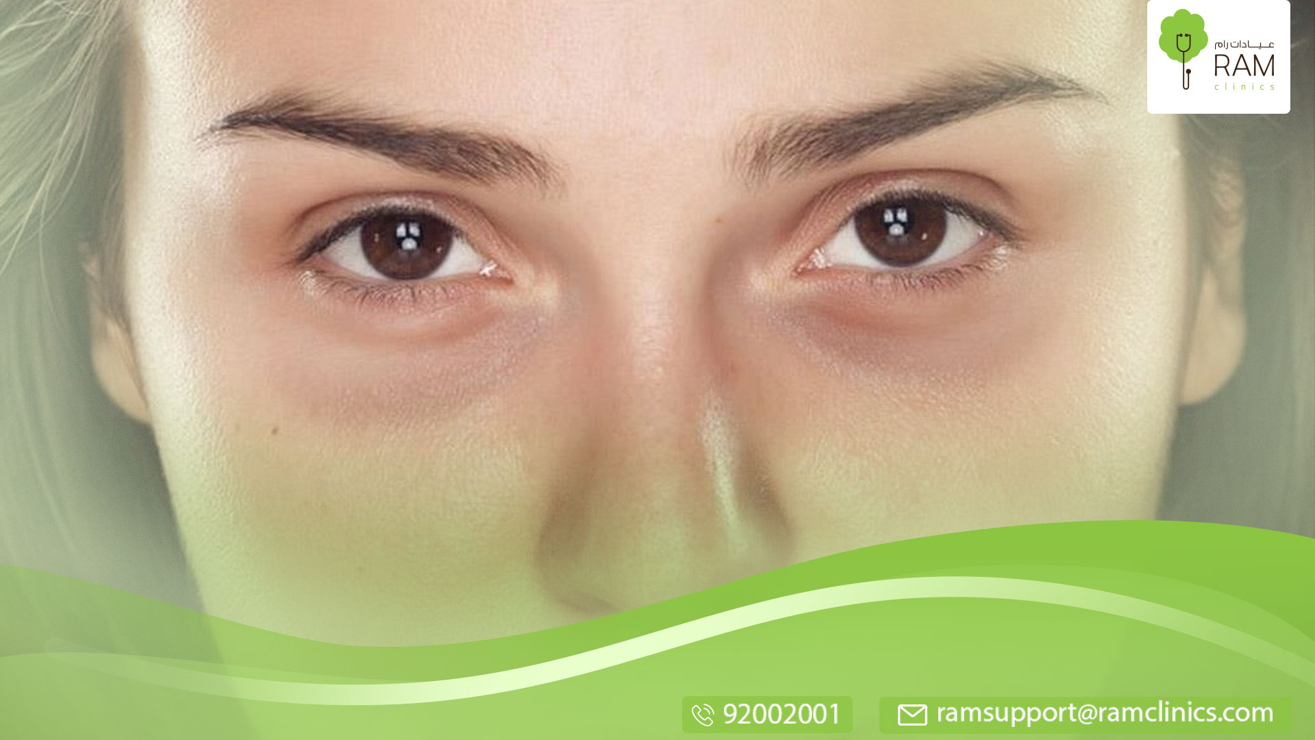 حان وقت علاج السواد تحت العين