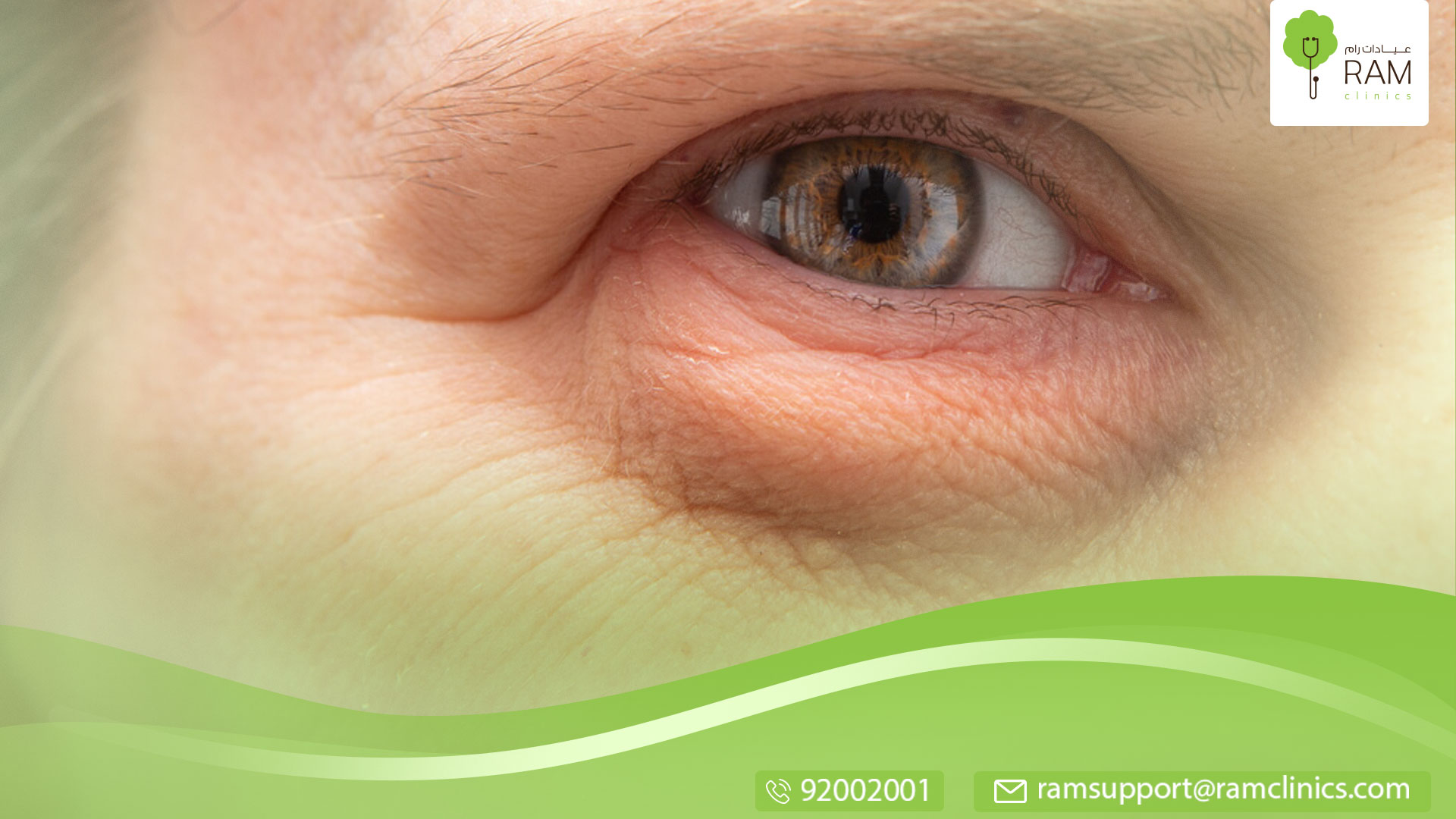 ما هي أسباب انتفاخ العين