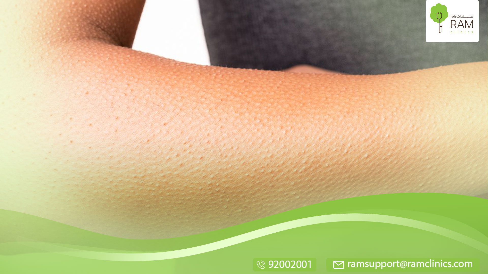 ندبة الجدرة