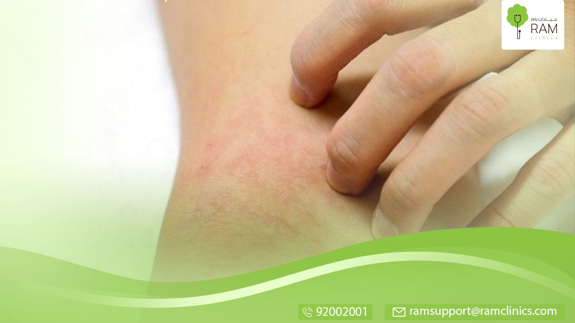 علاج الكلف طبيًا