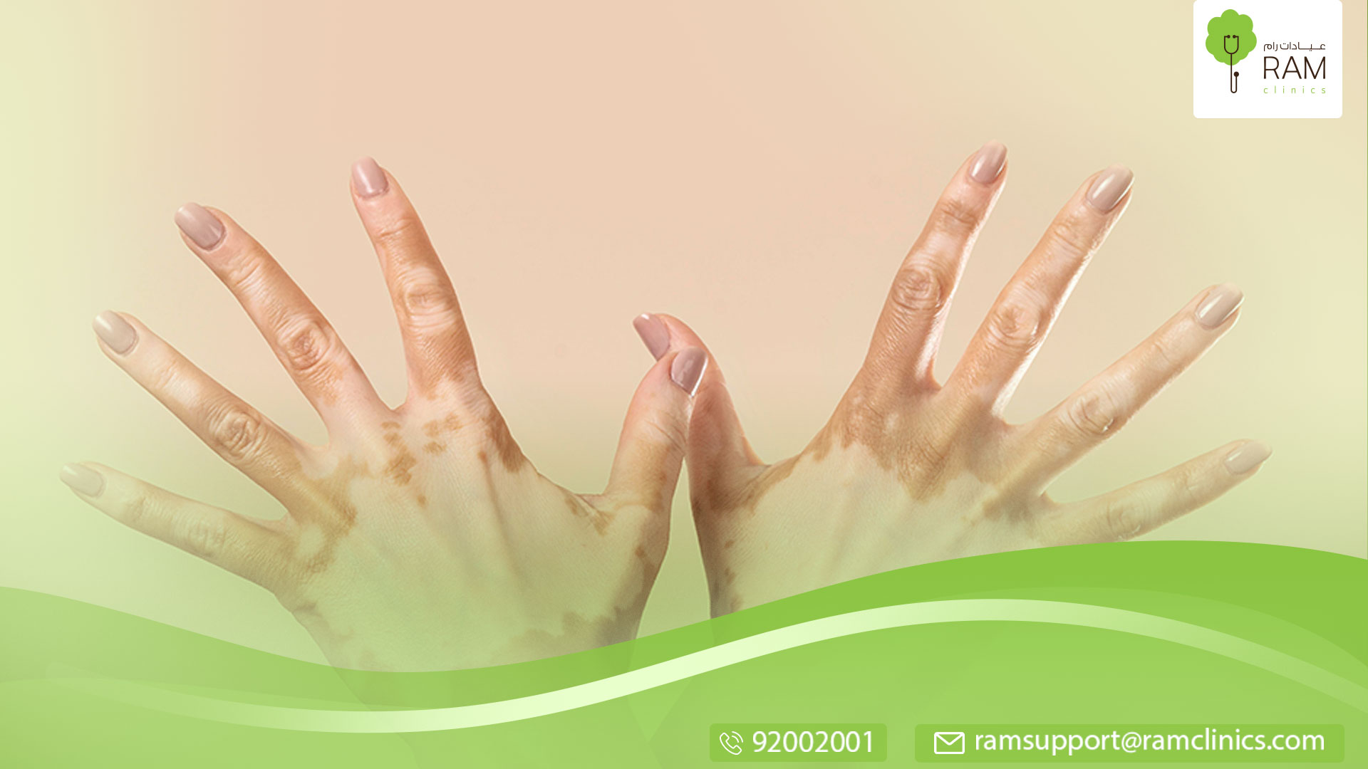 نقص التصبغ والبهاق