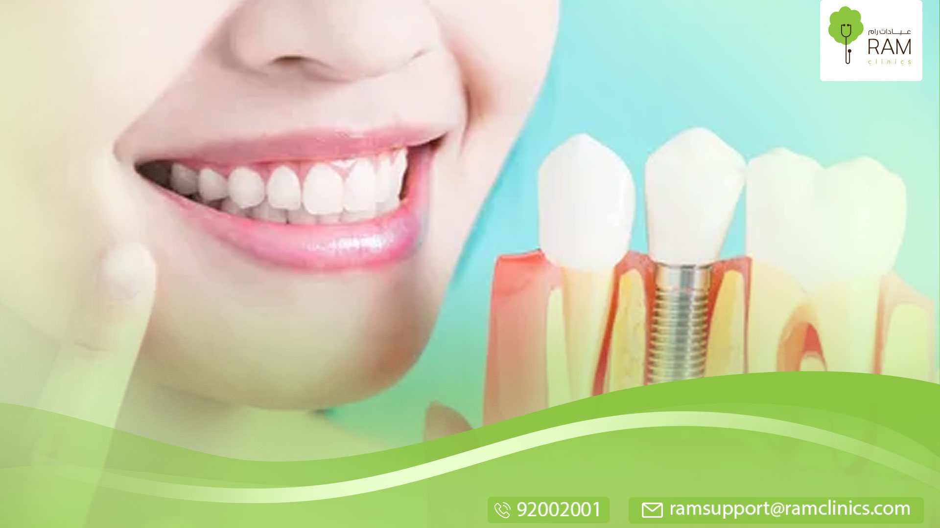 ألم زراعة الأسنان