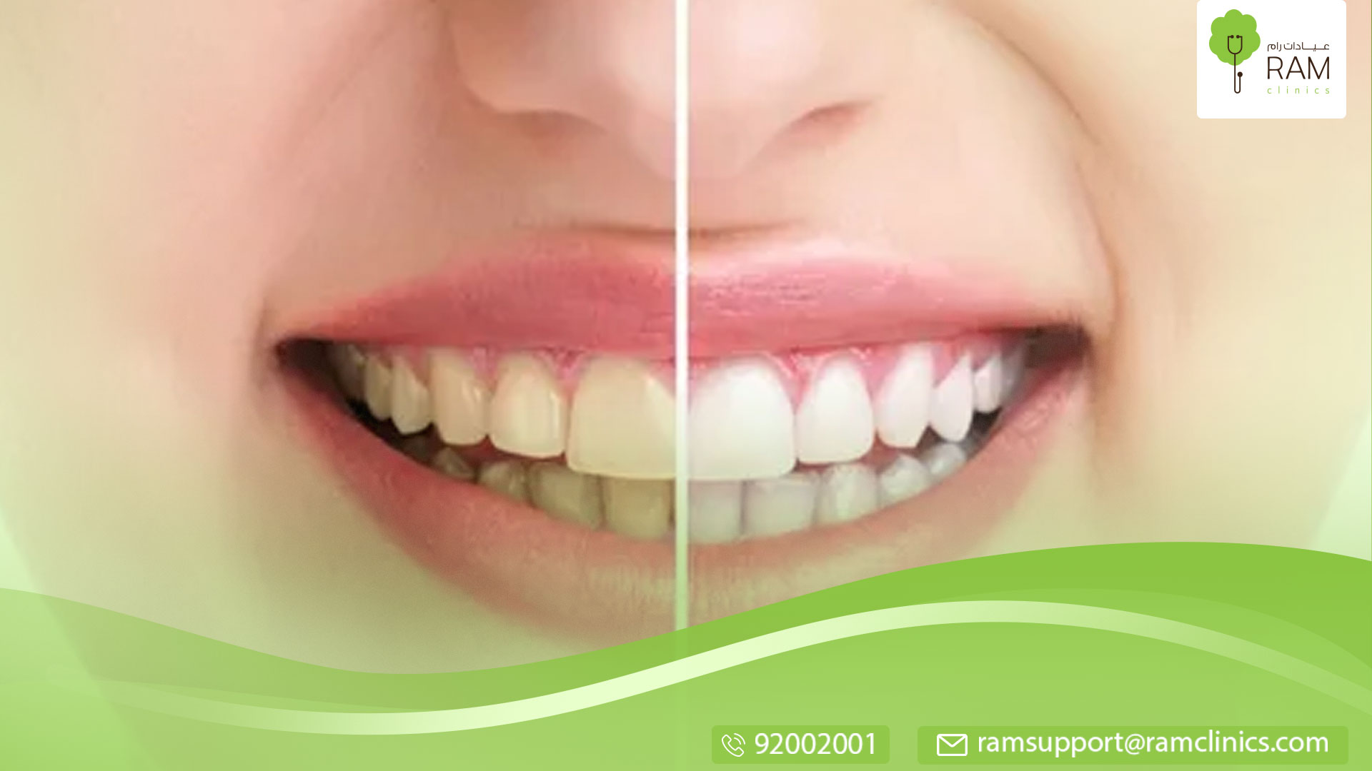 أفضل طرق لتبيض الأسنان