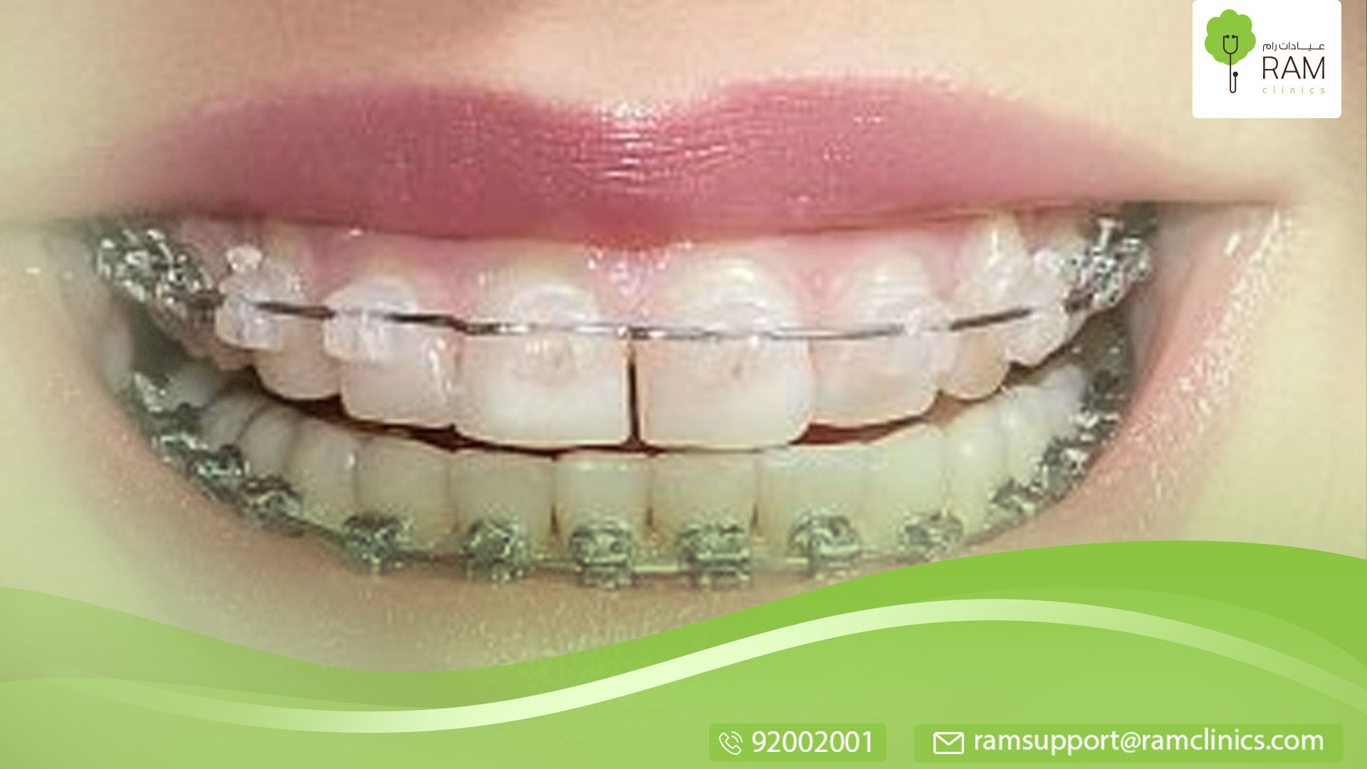 مثبت الأسنان بعد التقويم