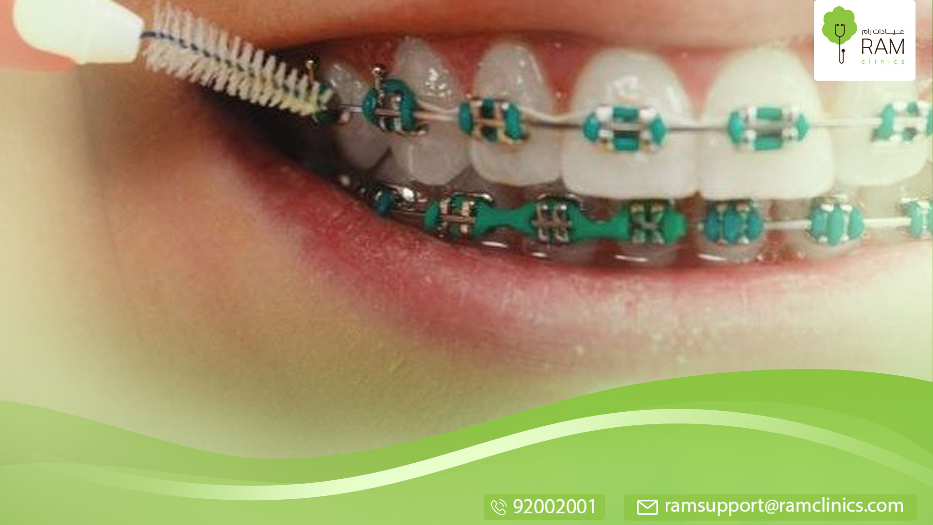 معلومات عن فراغات الأسنان