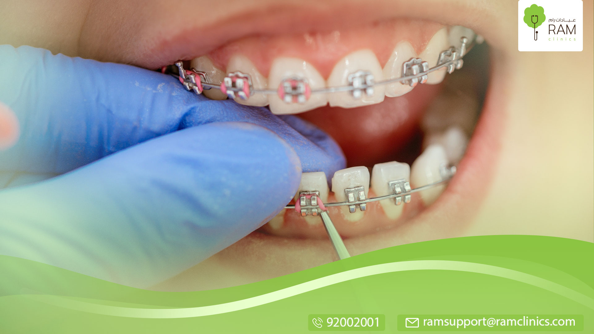 قبل تركيب تقويم الأسنان