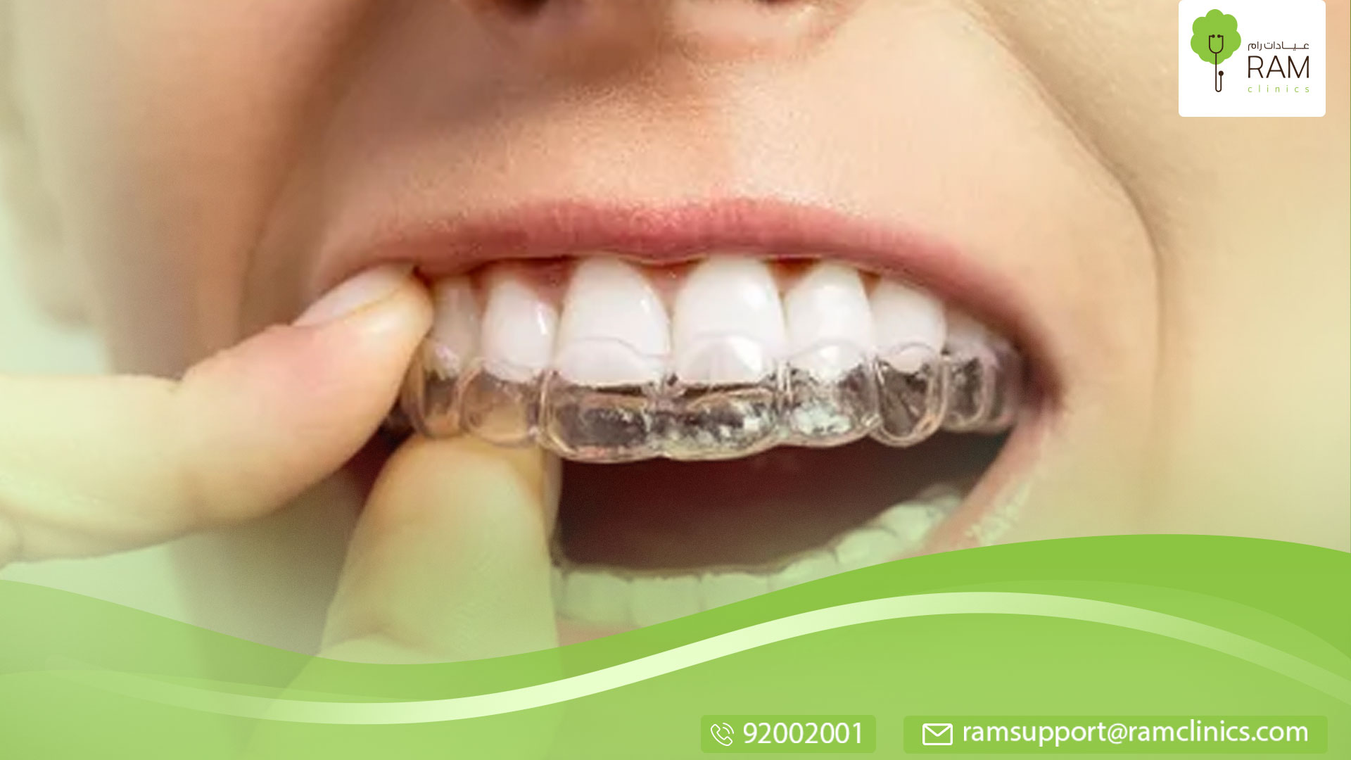 دليل حول تركيب الأسنان