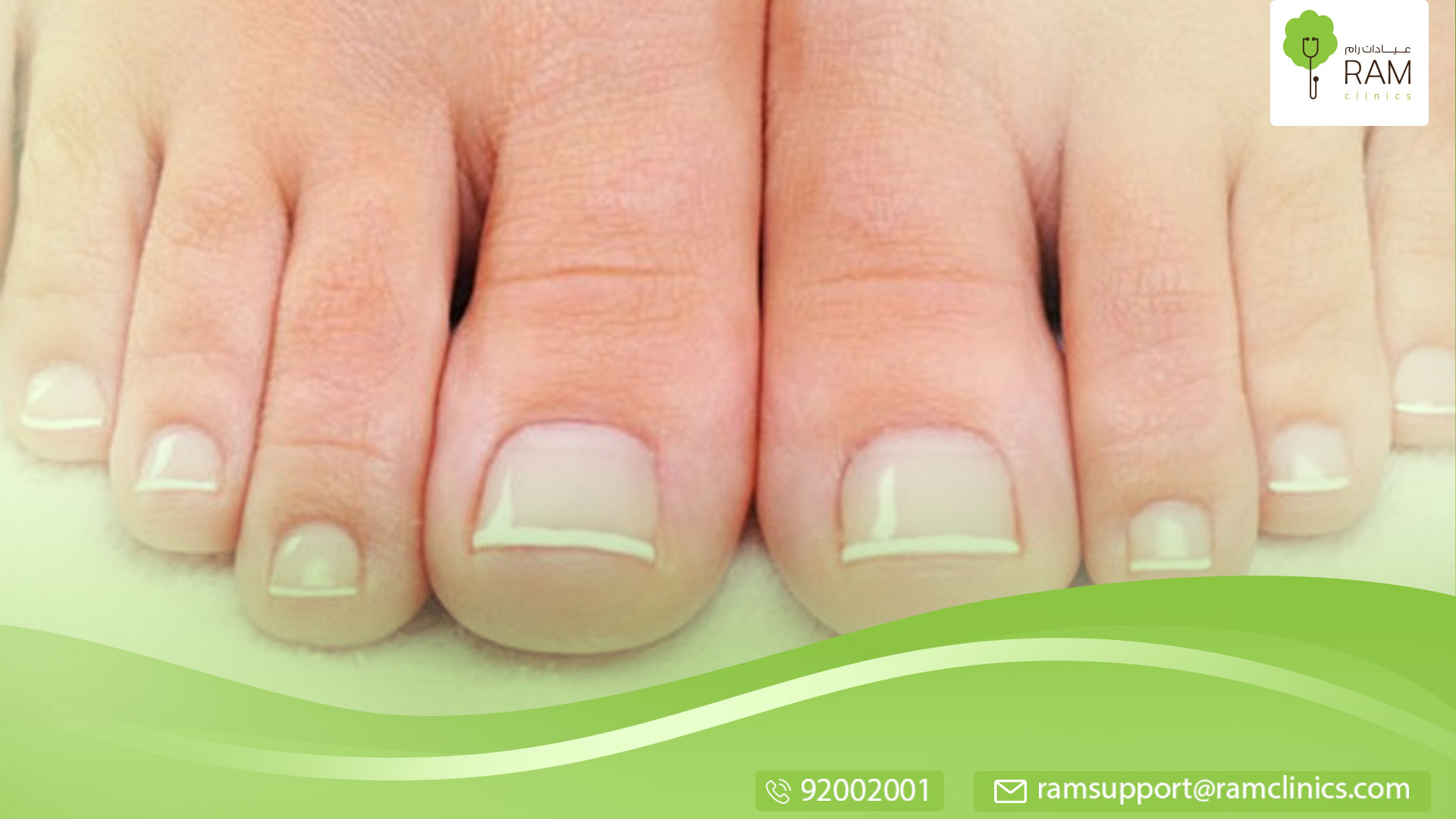 فطريات أظافر القدم: