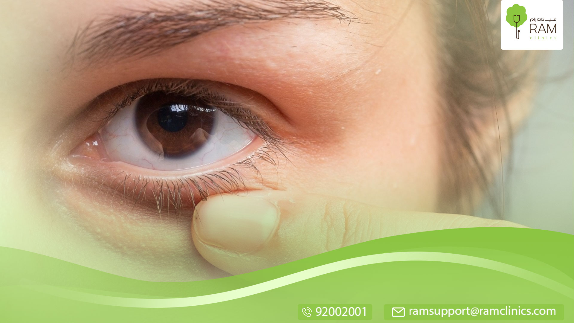 كيس-في-العين