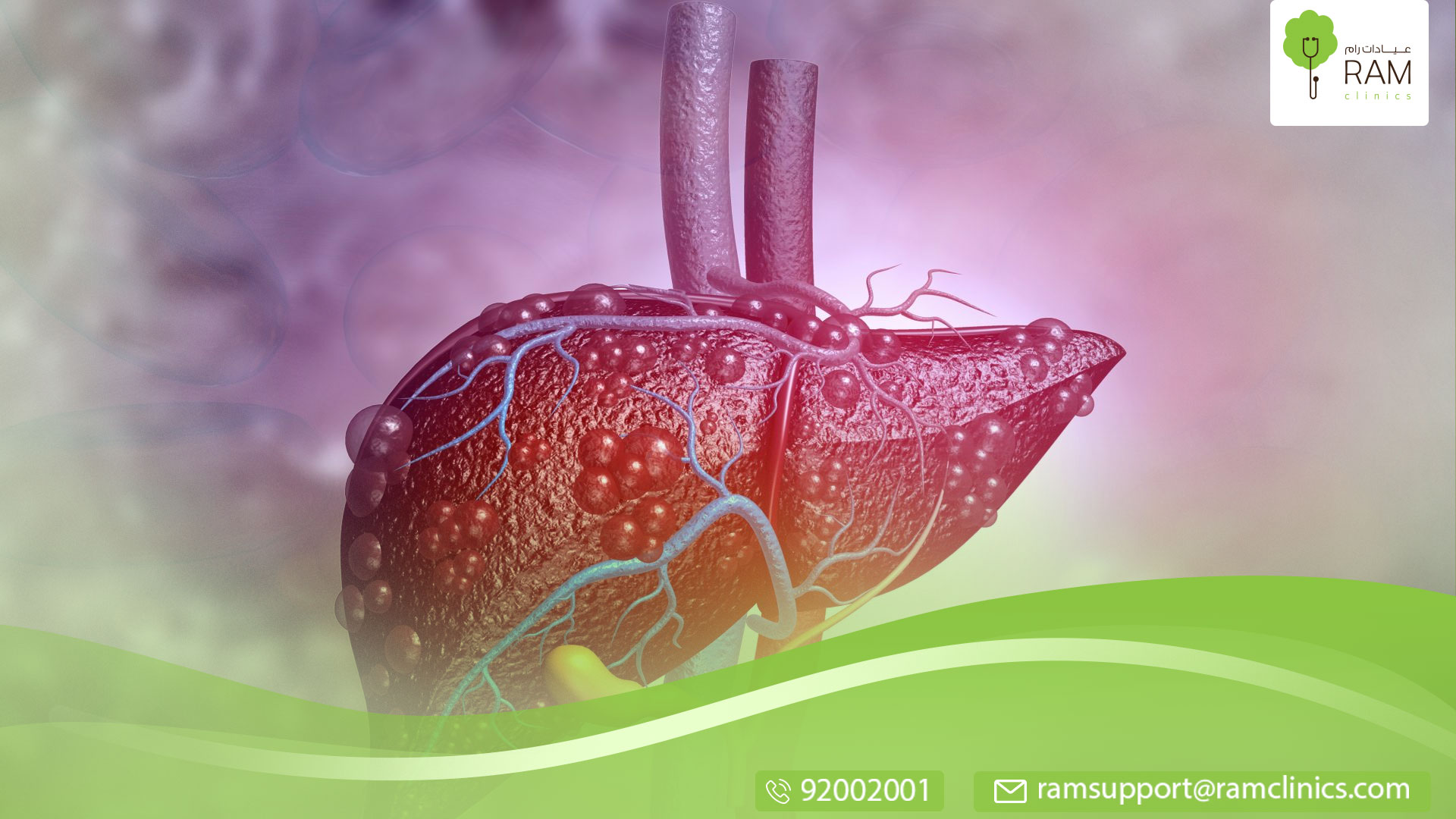 المرحلة الرابعة من سرطان الكبد