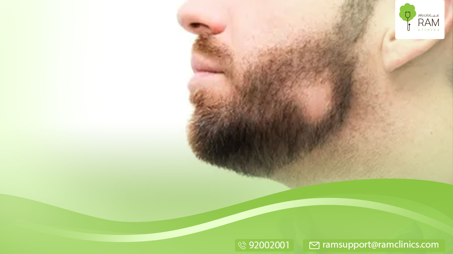 ثعلبة الذقن