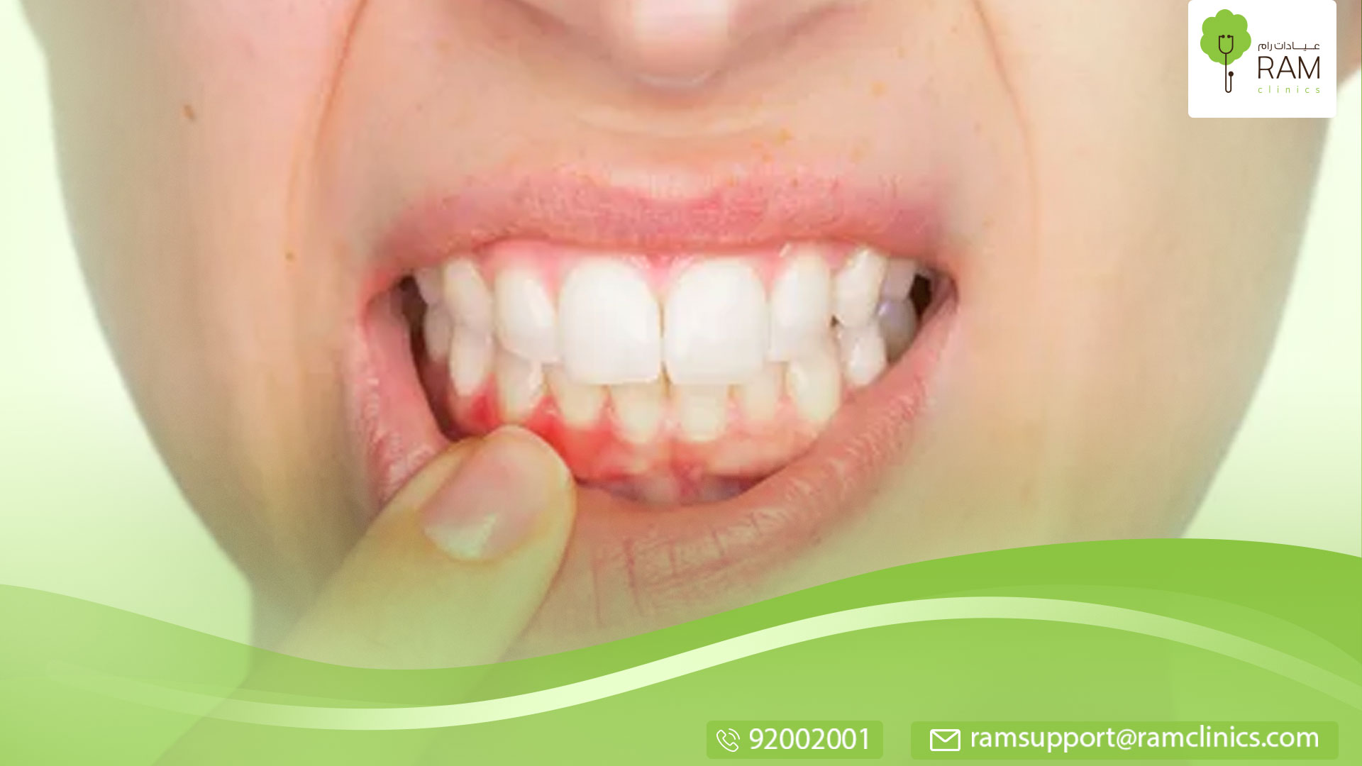 أسباب نزيف اللثة