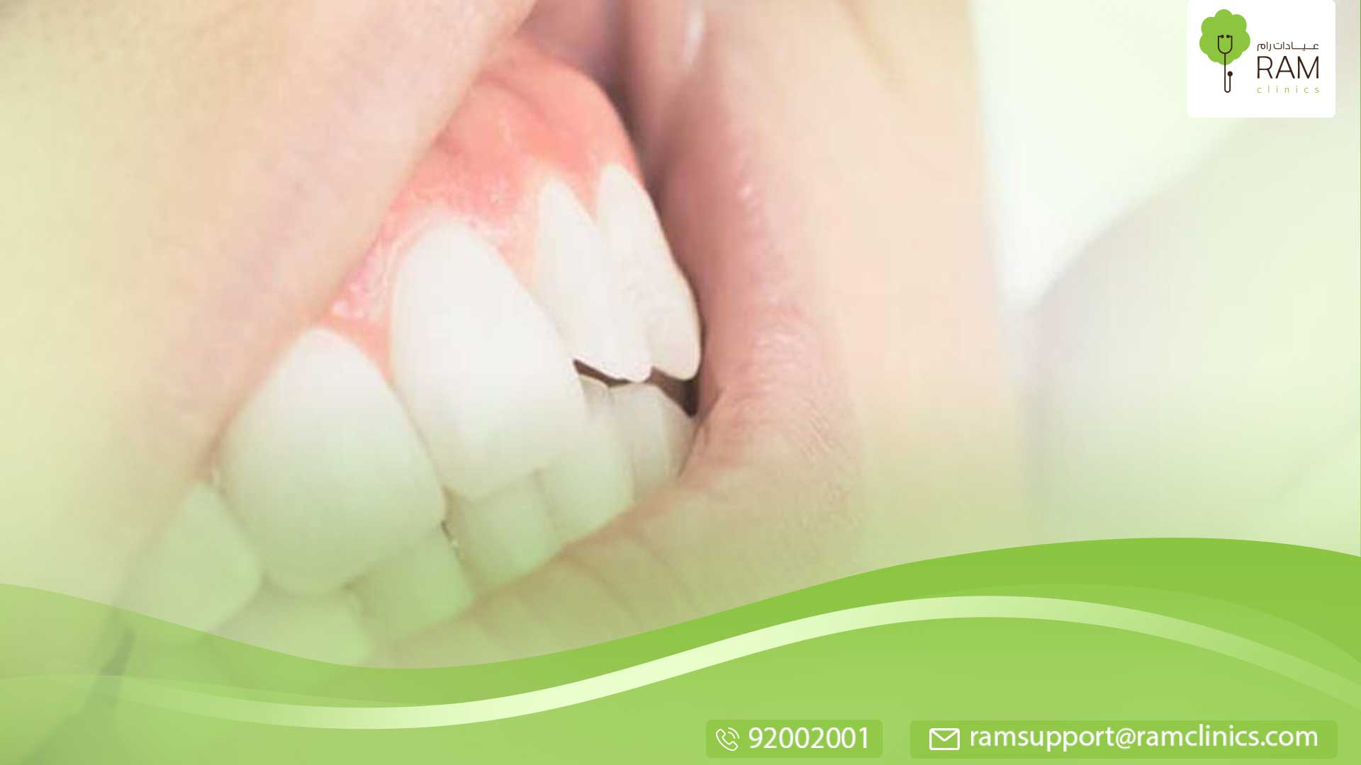 تآكل الأسنان الأمامية