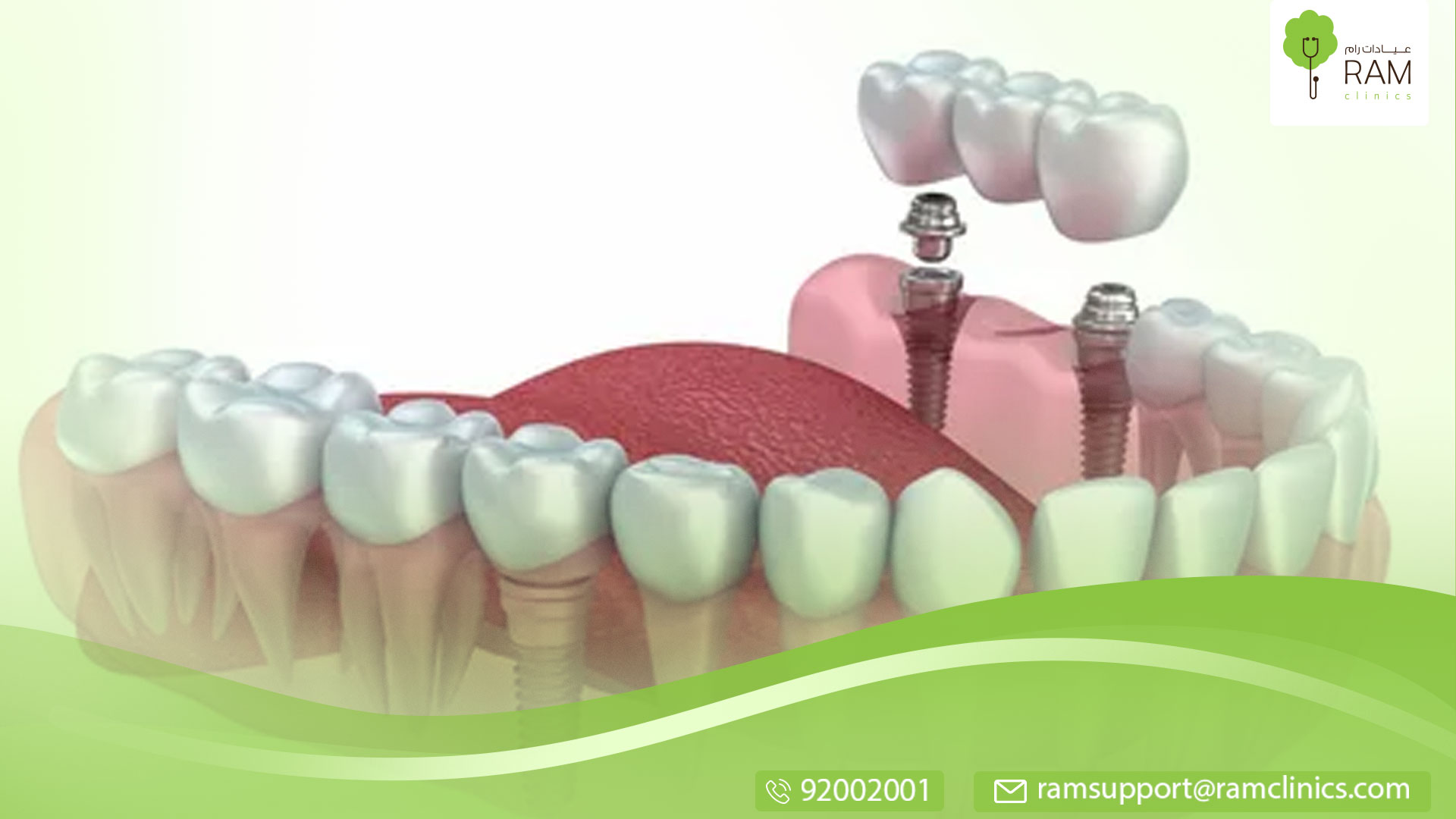 عملية زراعة الأسنان