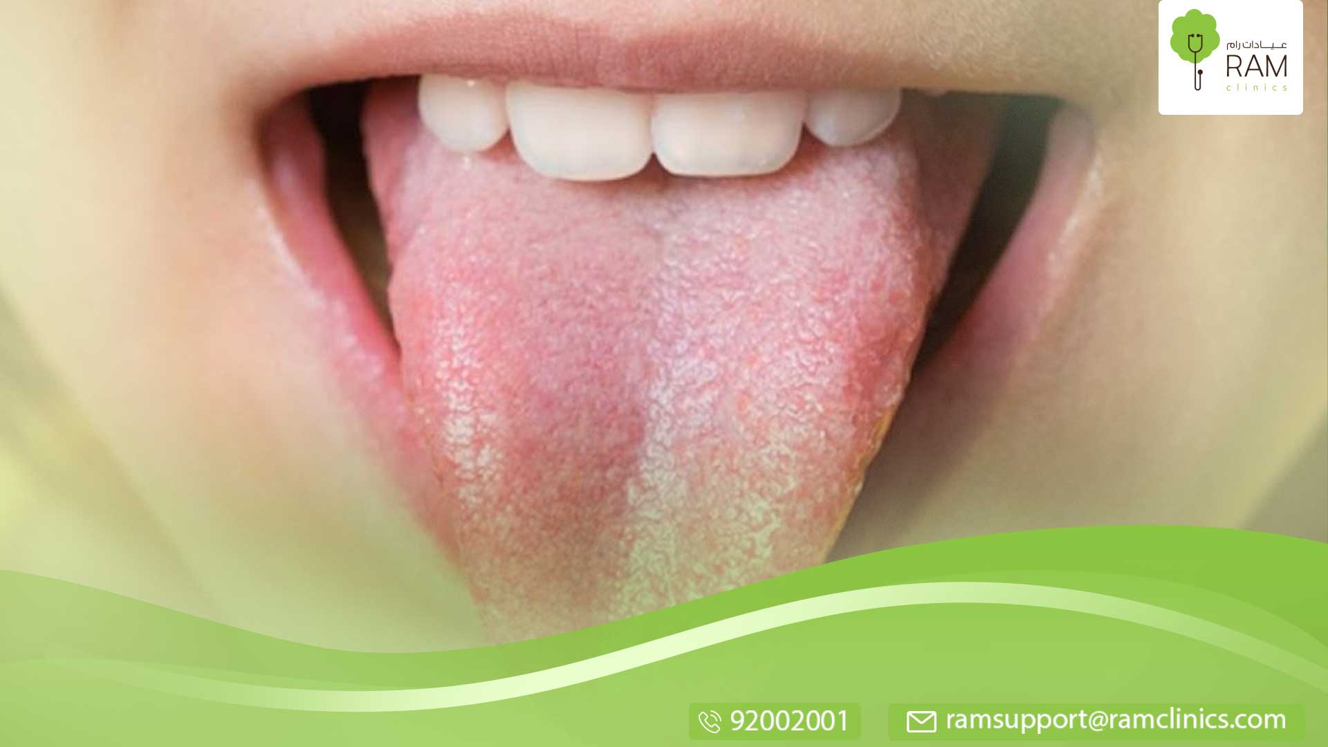 علاج-فطريات-اللسان-2