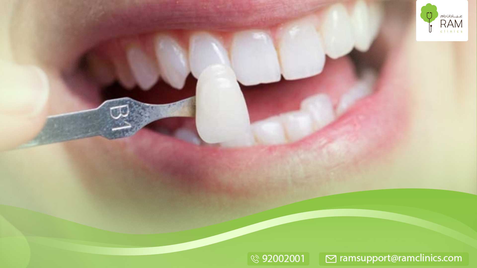 عملية زراعة الأسنان