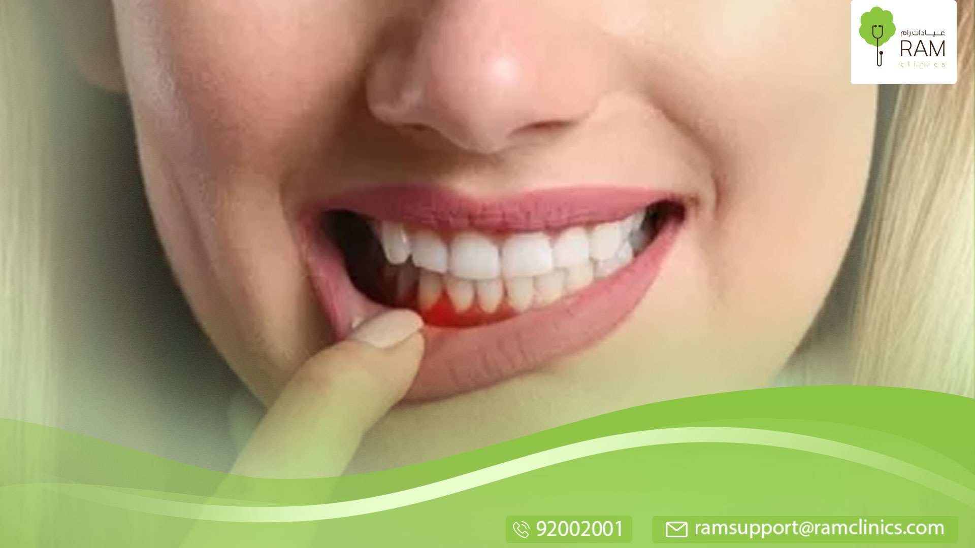 التهاب اللثة التقرحي