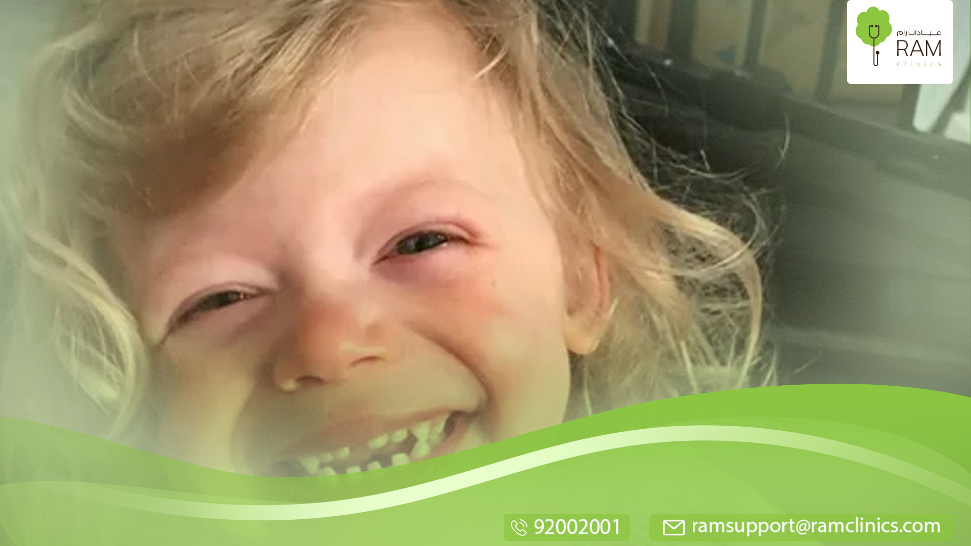 متلازمة ويليام