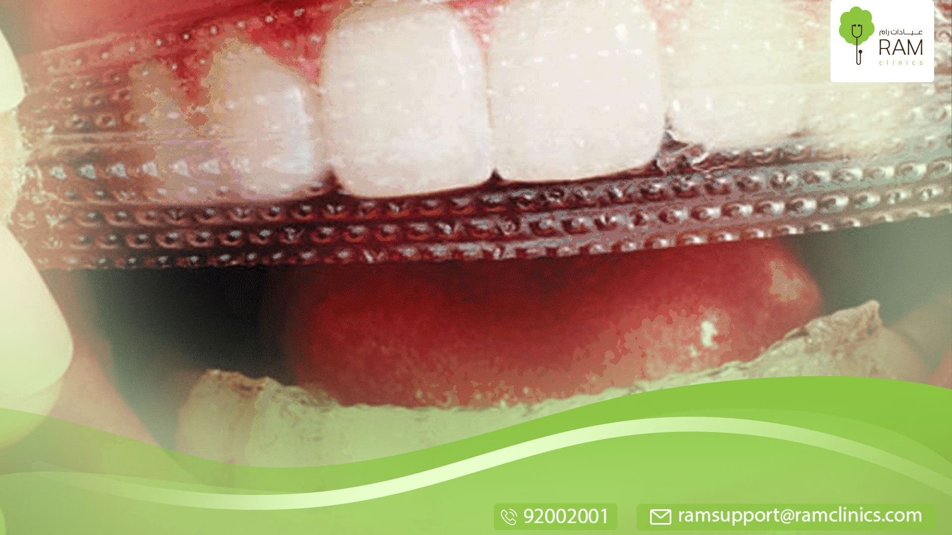 لصقات تبييض الأسنان