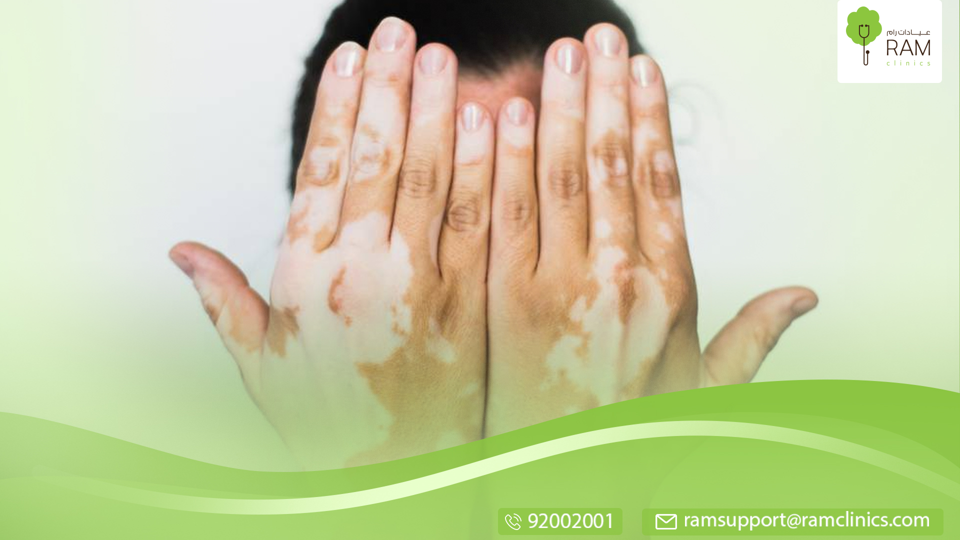 نقص التصبغ والبهاق