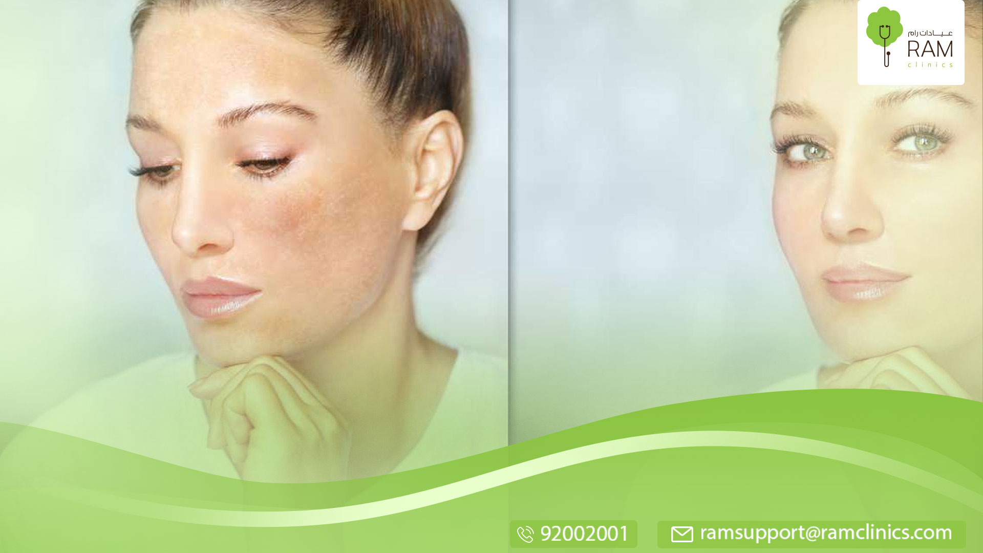 زيادة صبغة الميلانين